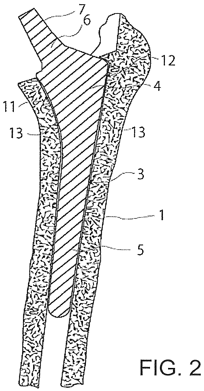 Patent US12376866 Figure 2 – Thin-blade chisel system