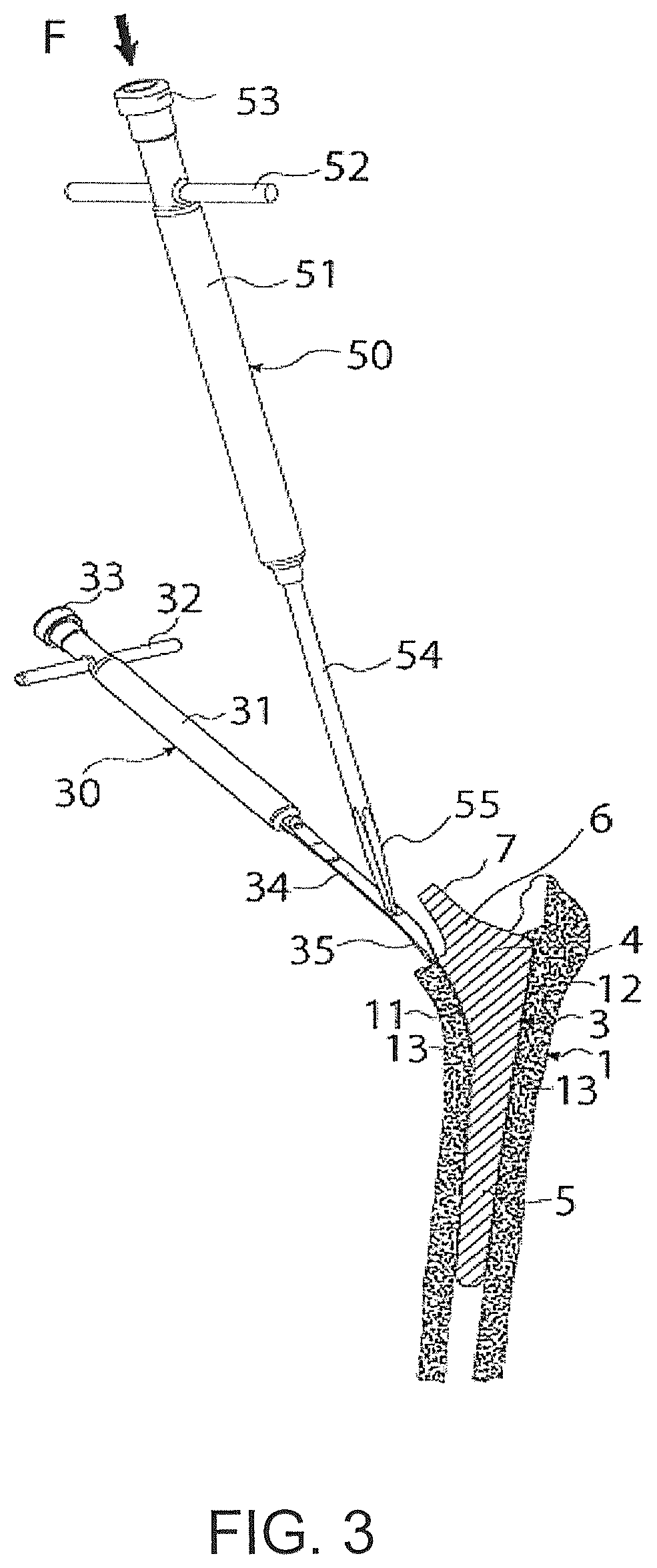 Patent US12376866 Figure 3 – Thin-blade chisel system