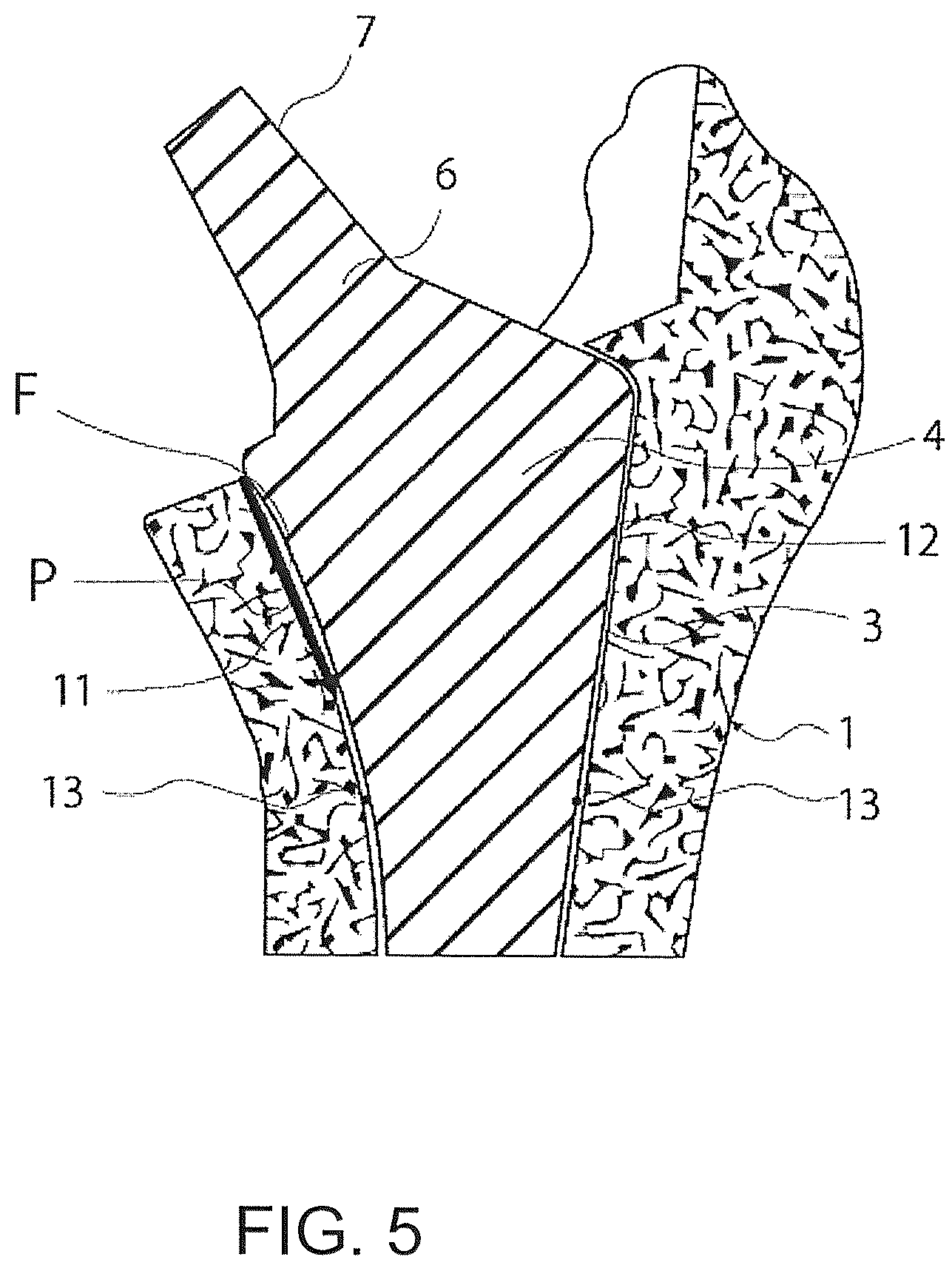 Patent US12376866 Figure 5 – Thin-blade chisel system