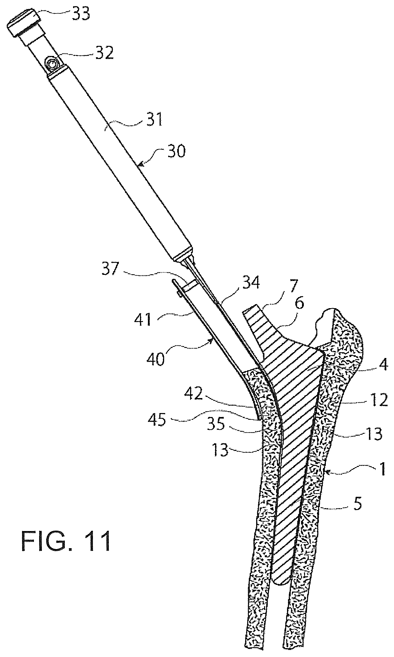 Patent US12376866 Figure 11 – Thin-blade chisel system