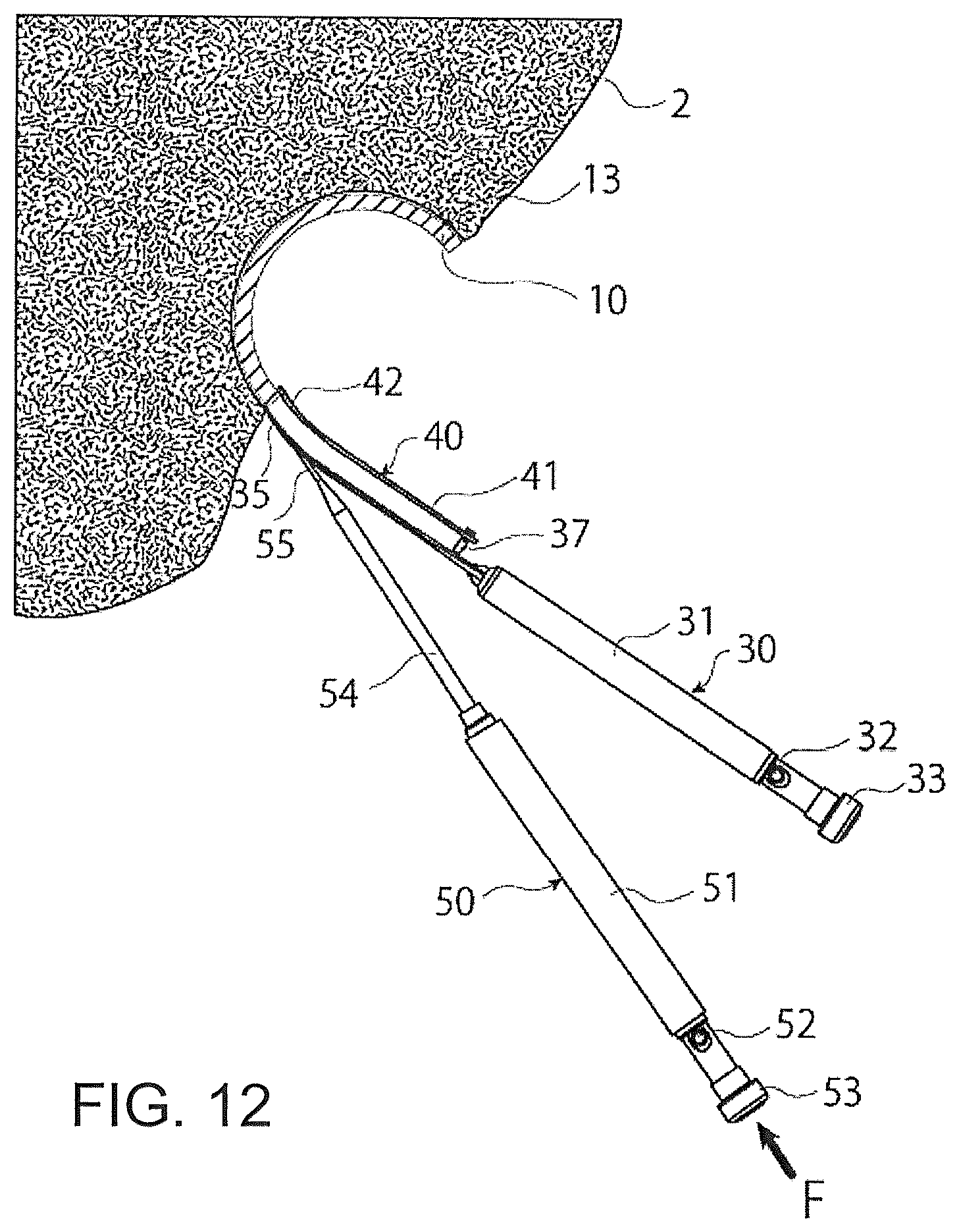 Patent US12376866 Figure 12 – Thin-blade chisel system