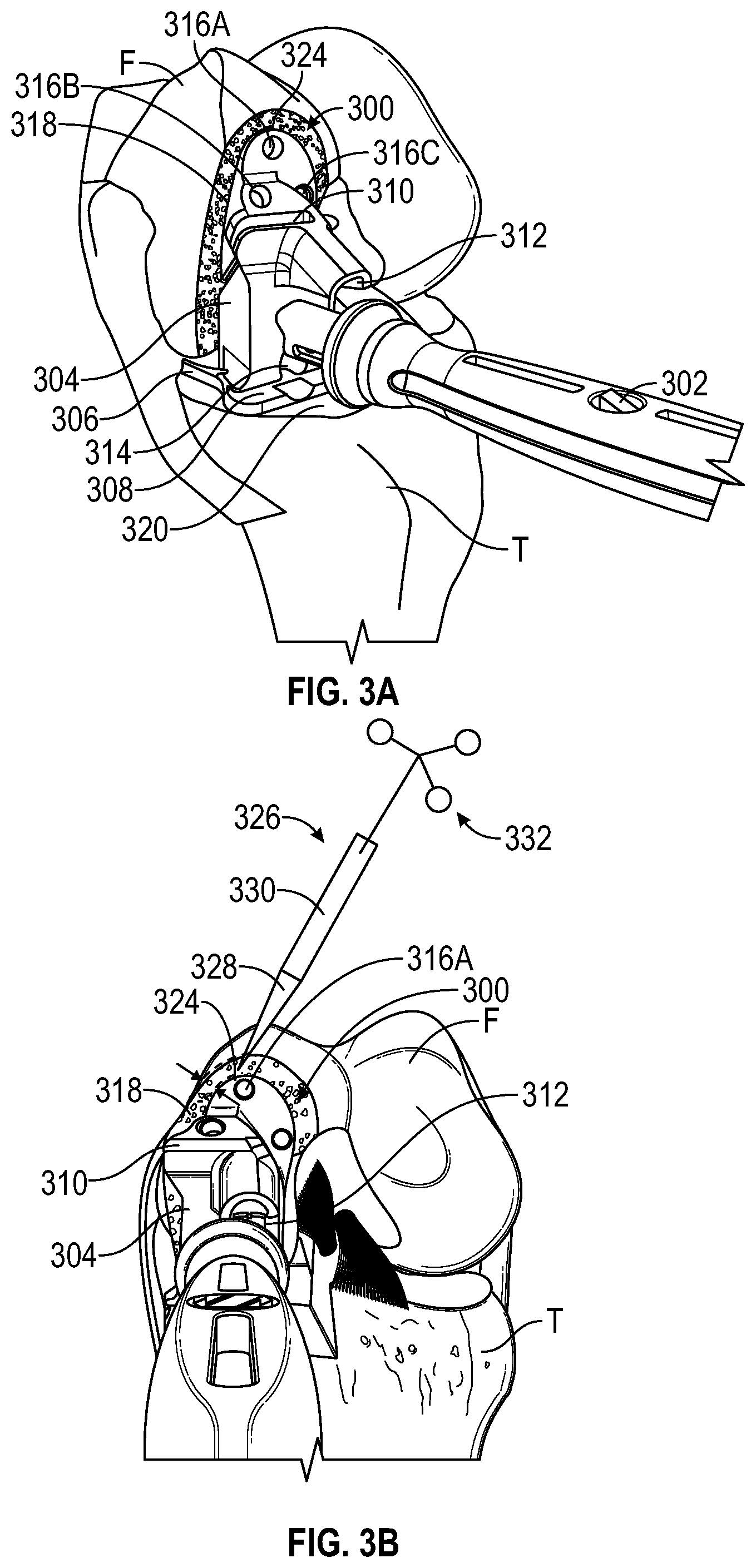 Patent US12376868 Figure 3 – Devices and methods for posterior resection in robotically assisted partial knee arthroplasties