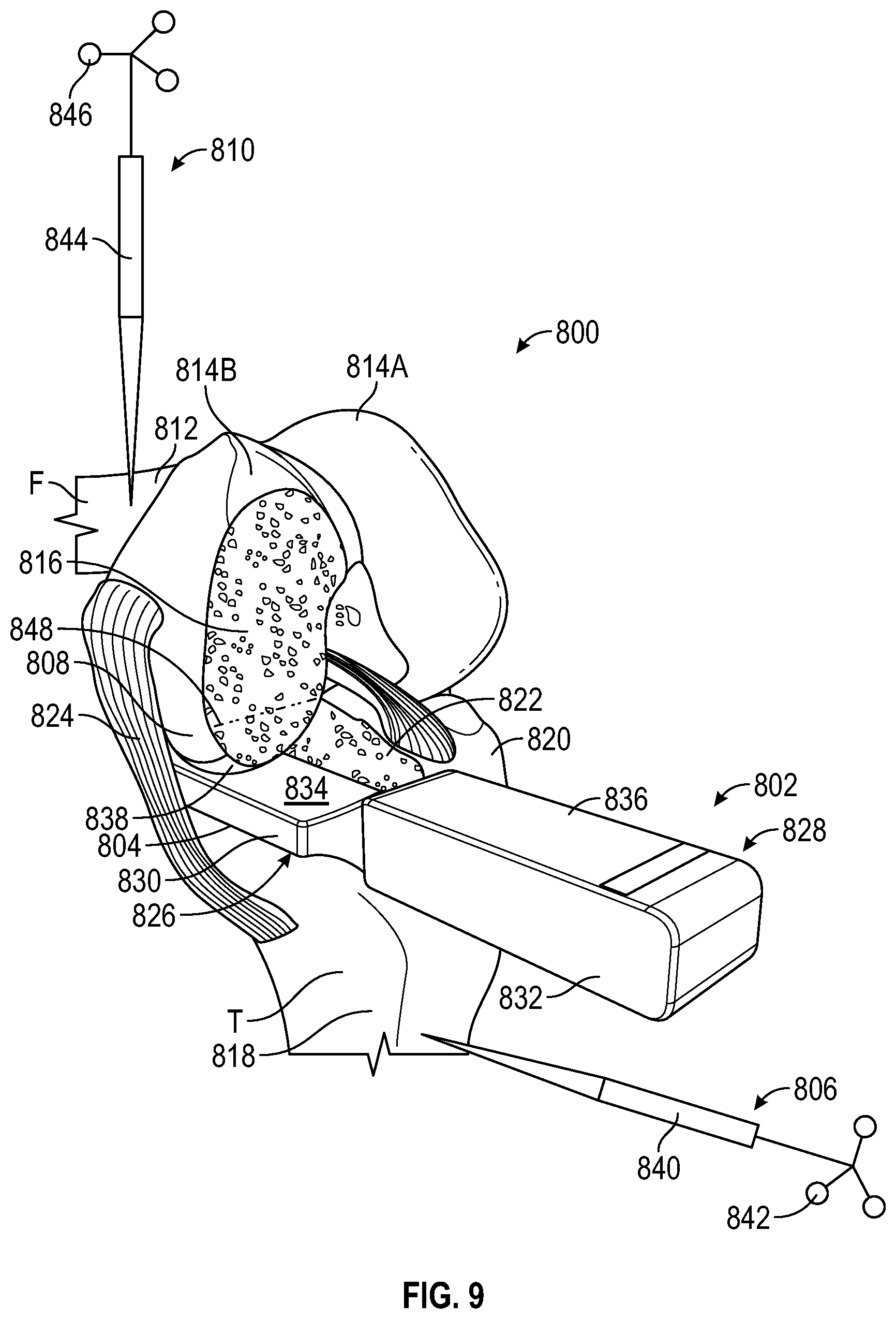 Patent US12376868 Figure 13 – Devices and methods for posterior resection in robotically assisted partial knee arthroplasties