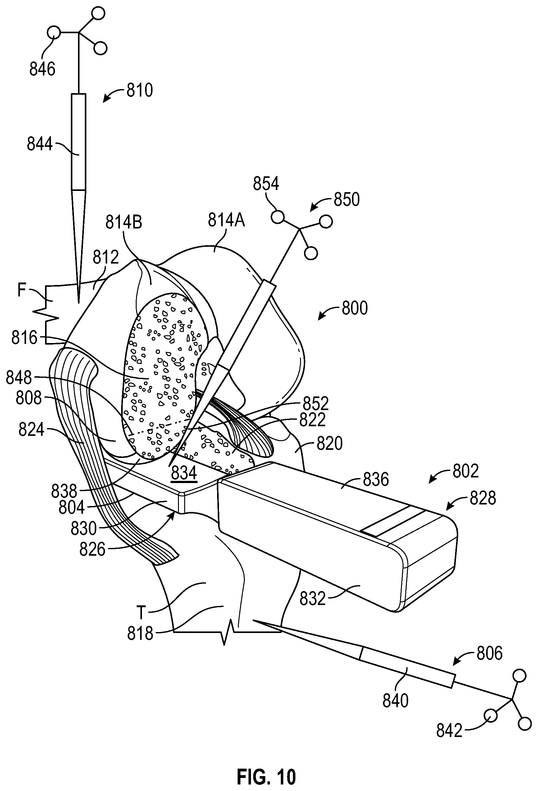 Patent US12376868 Figure 14 – Devices and methods for posterior resection in robotically assisted partial knee arthroplasties