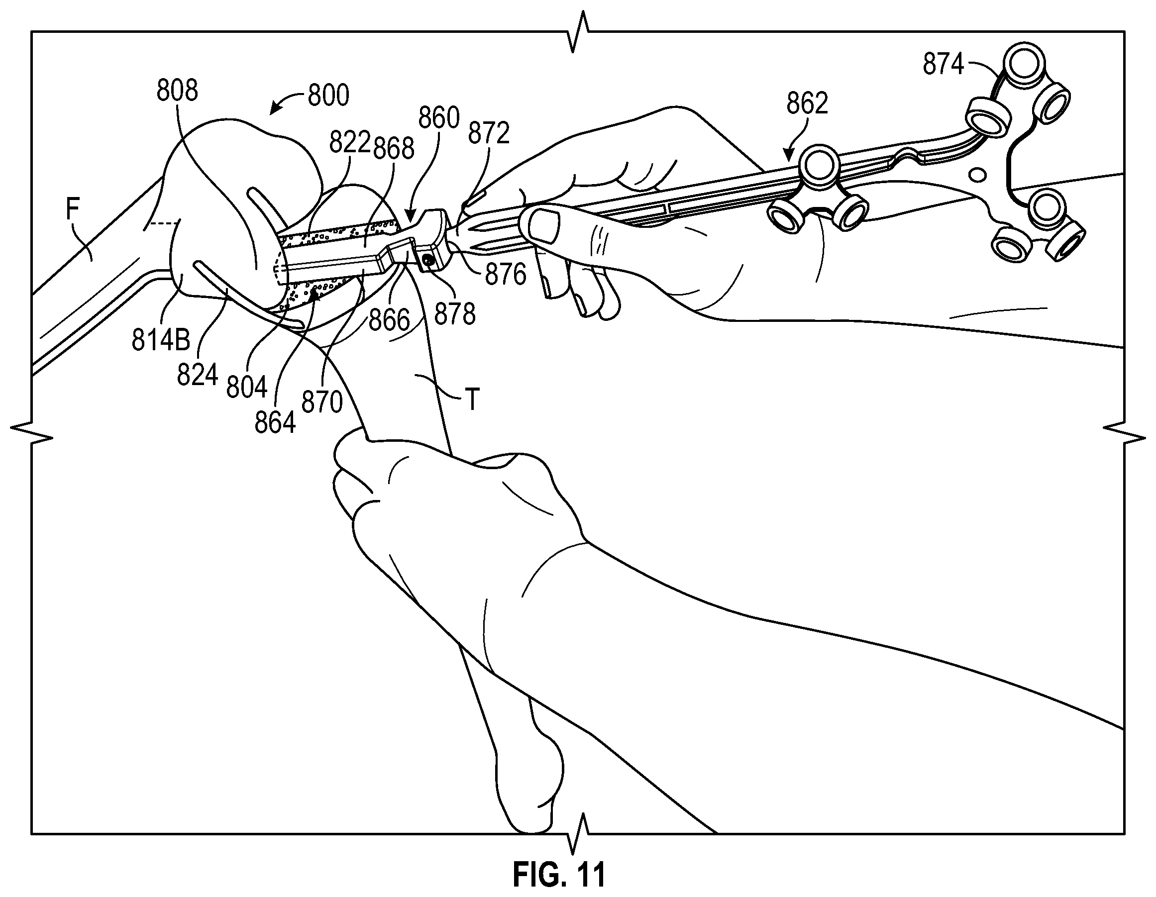 Patent US12376868 Figure 15 – Devices and methods for posterior resection in robotically assisted partial knee arthroplasties