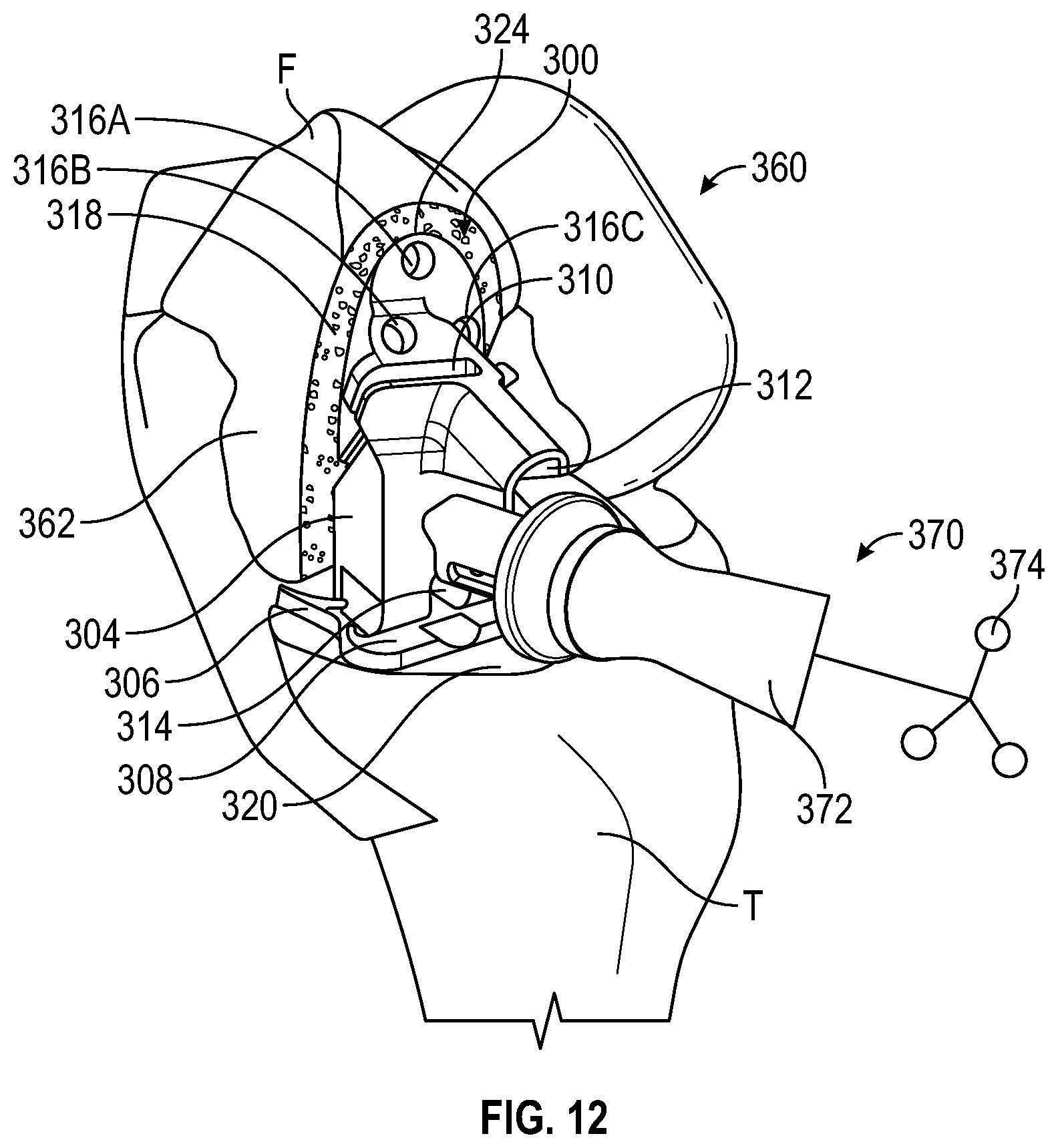 Patent US12376868 Figure 16 – Devices and methods for posterior resection in robotically assisted partial knee arthroplasties