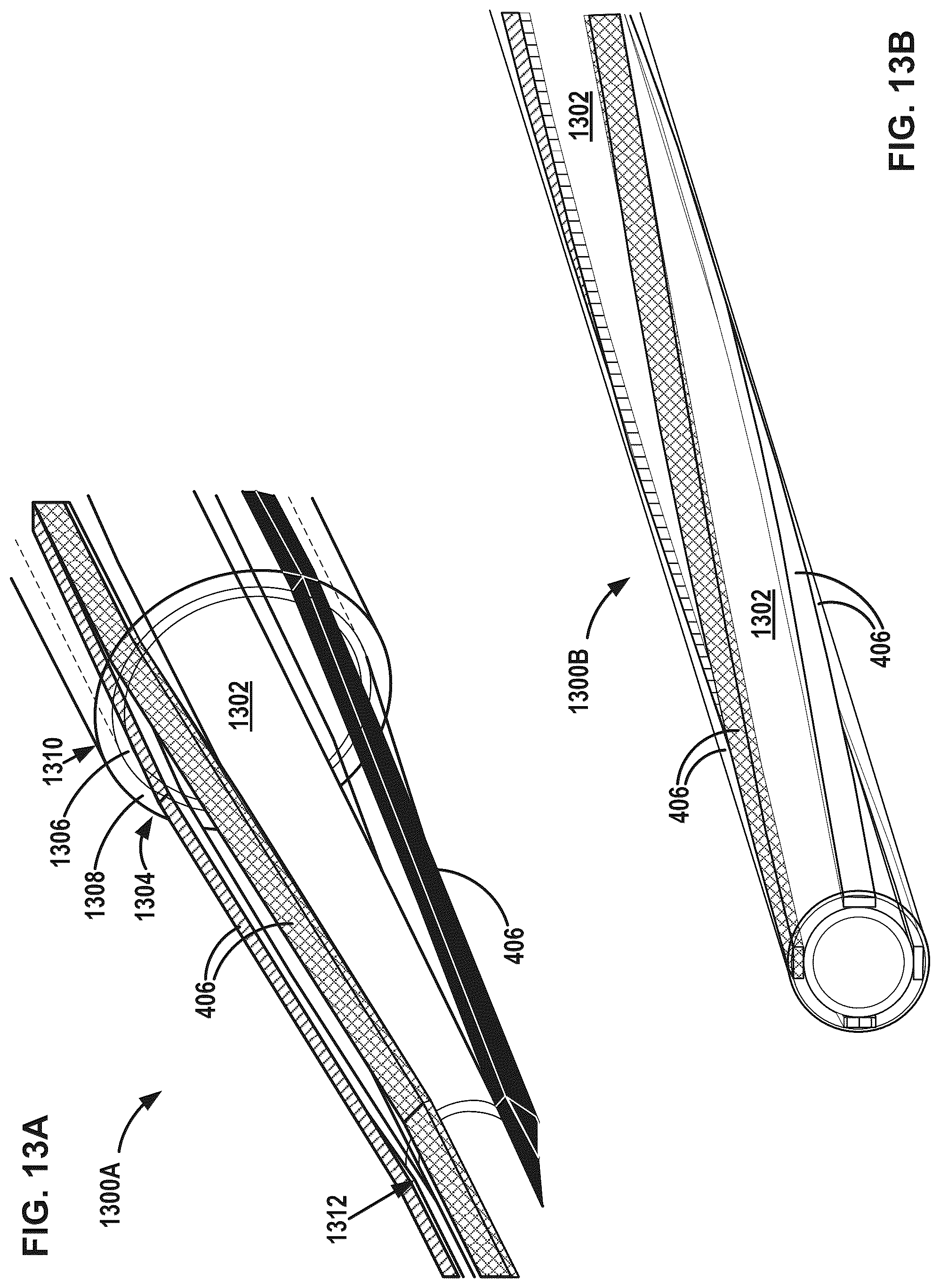 Patent US12376869 Figure 16 – Intravascular lithotripsy