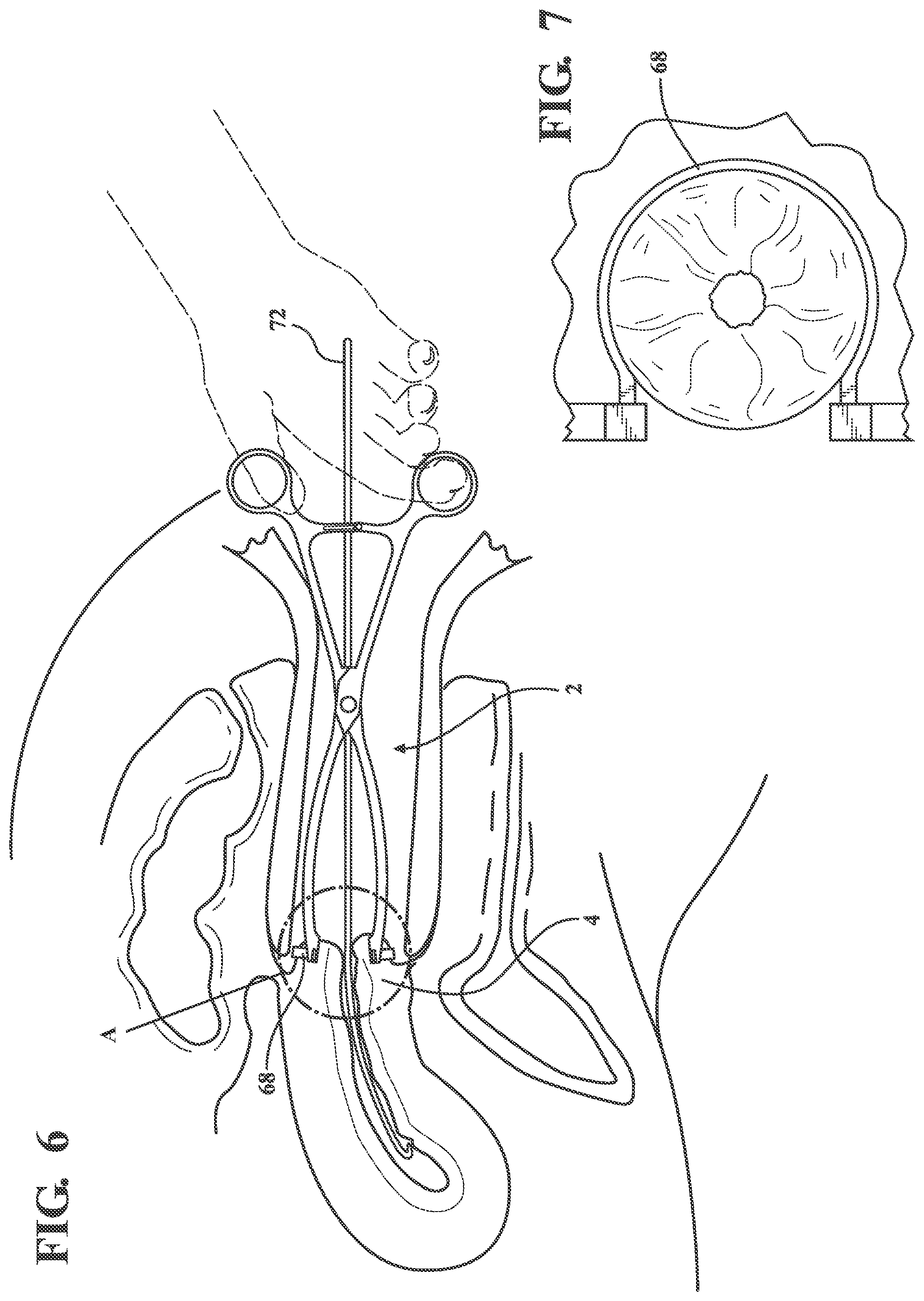 Patent US12376871 Figure 5 – Atraumatic tenaculum for facilitation of transcervical procedures
