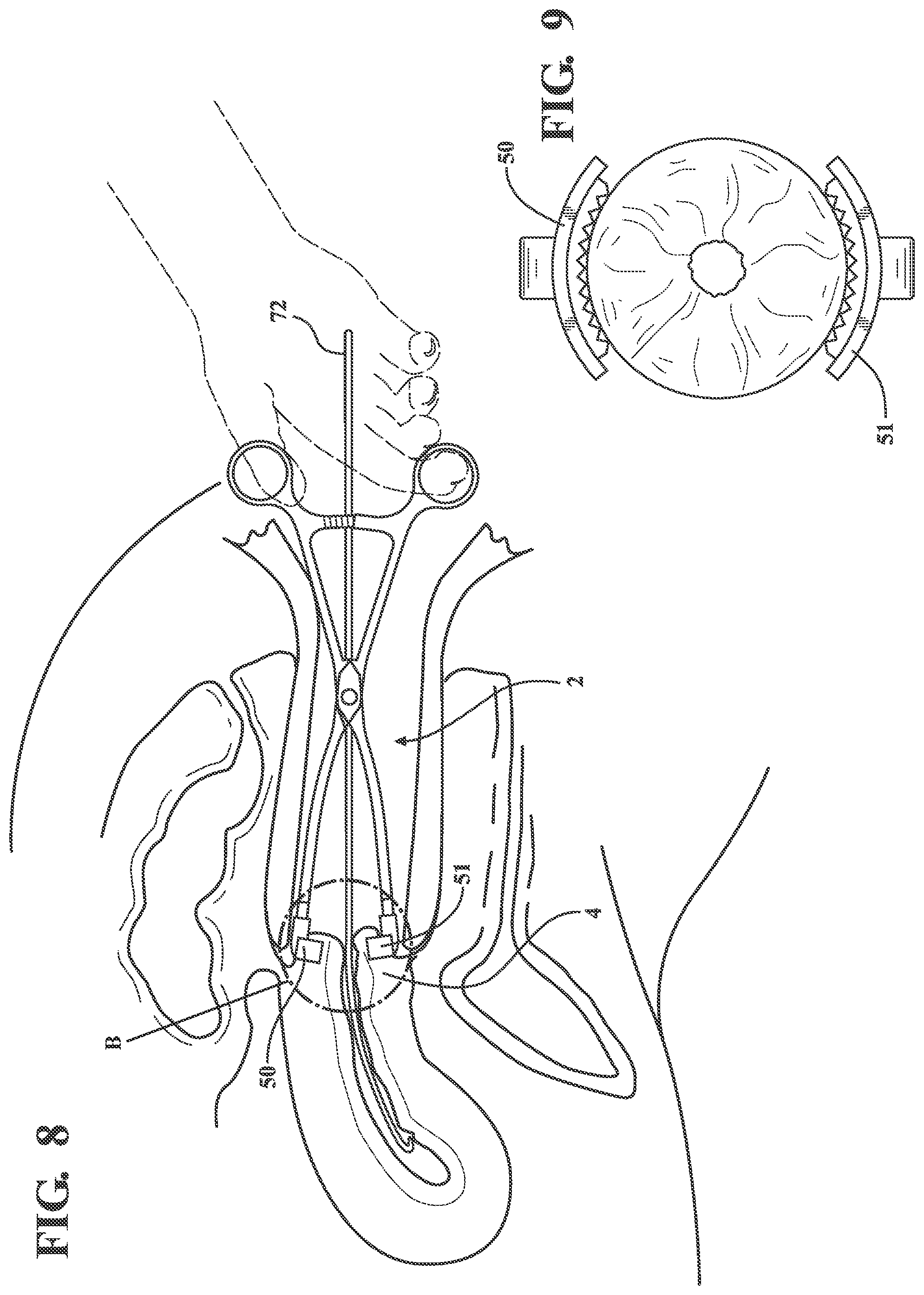 Patent US12376871 Figure 6 – Atraumatic tenaculum for facilitation of transcervical procedures