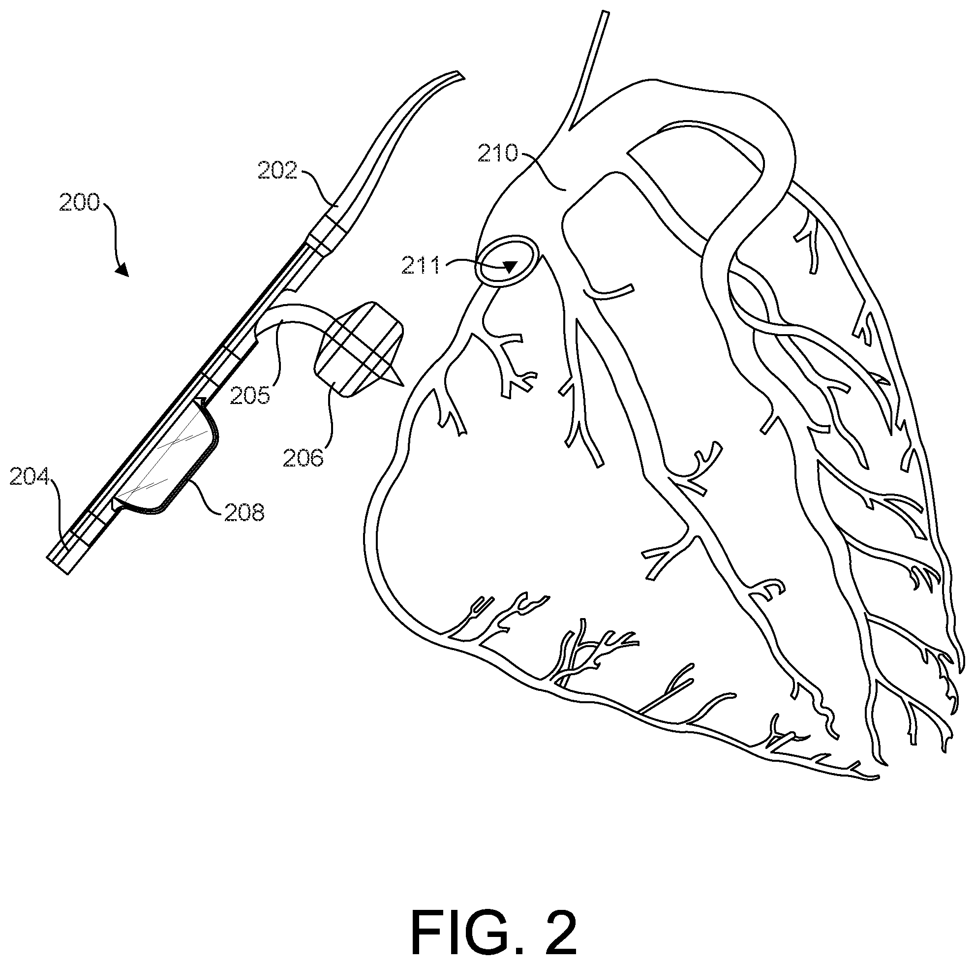 Patent US12376879 Figure 2 – Expandable elements for shunting catheters