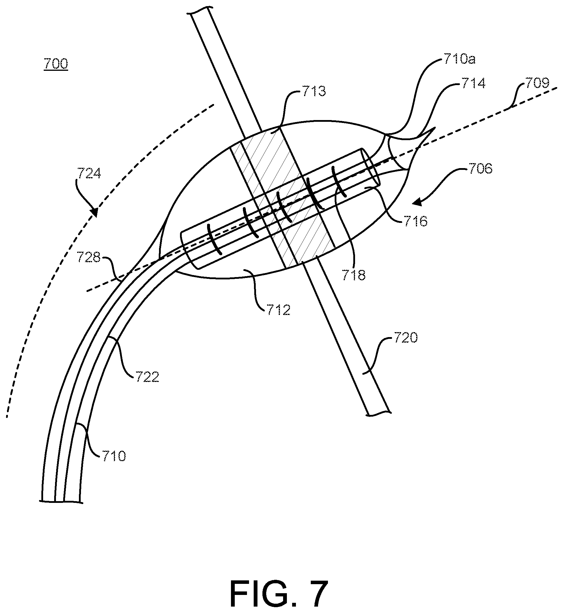 Patent US12376879 Figure 11 – Expandable elements for shunting catheters