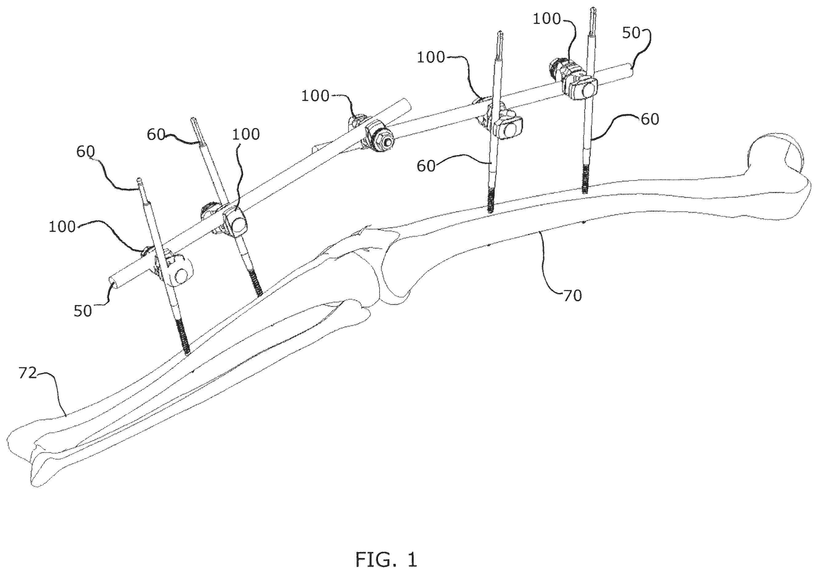 Patent US12376885 Figure 1 – External fixator assembly