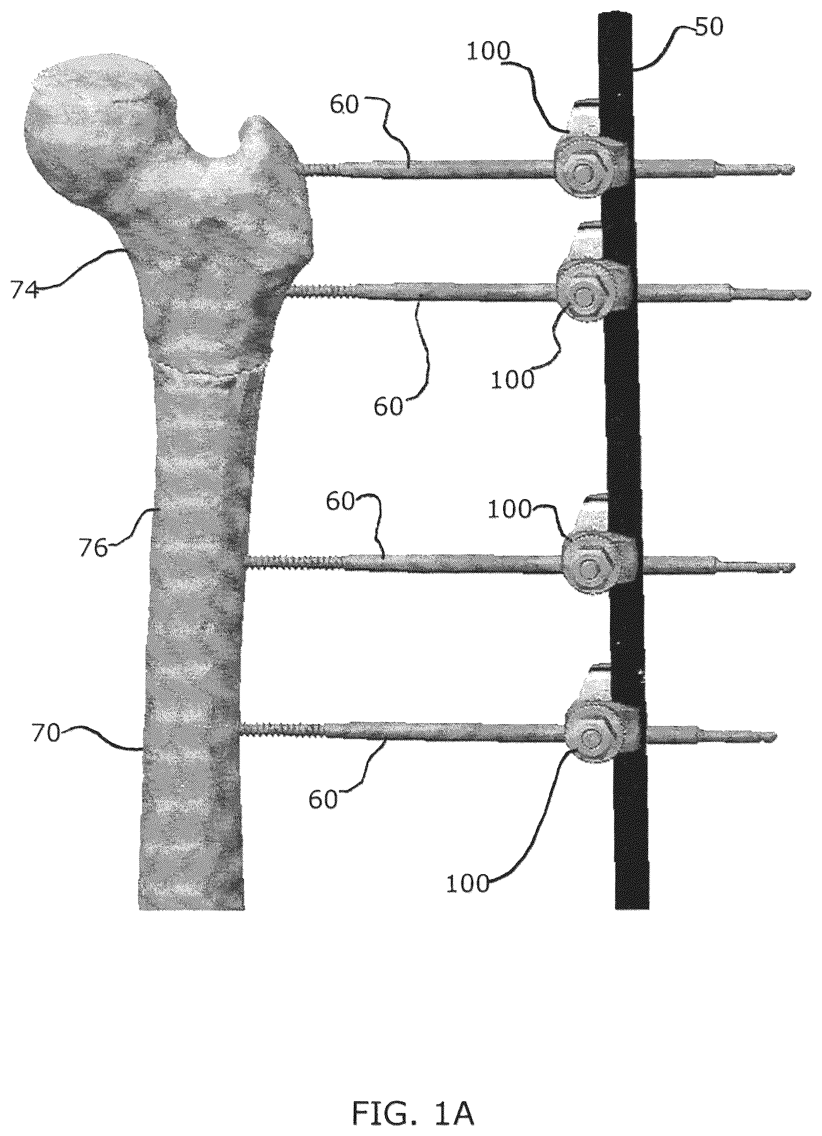 Patent US12376885 Figure 2 – External fixator assembly