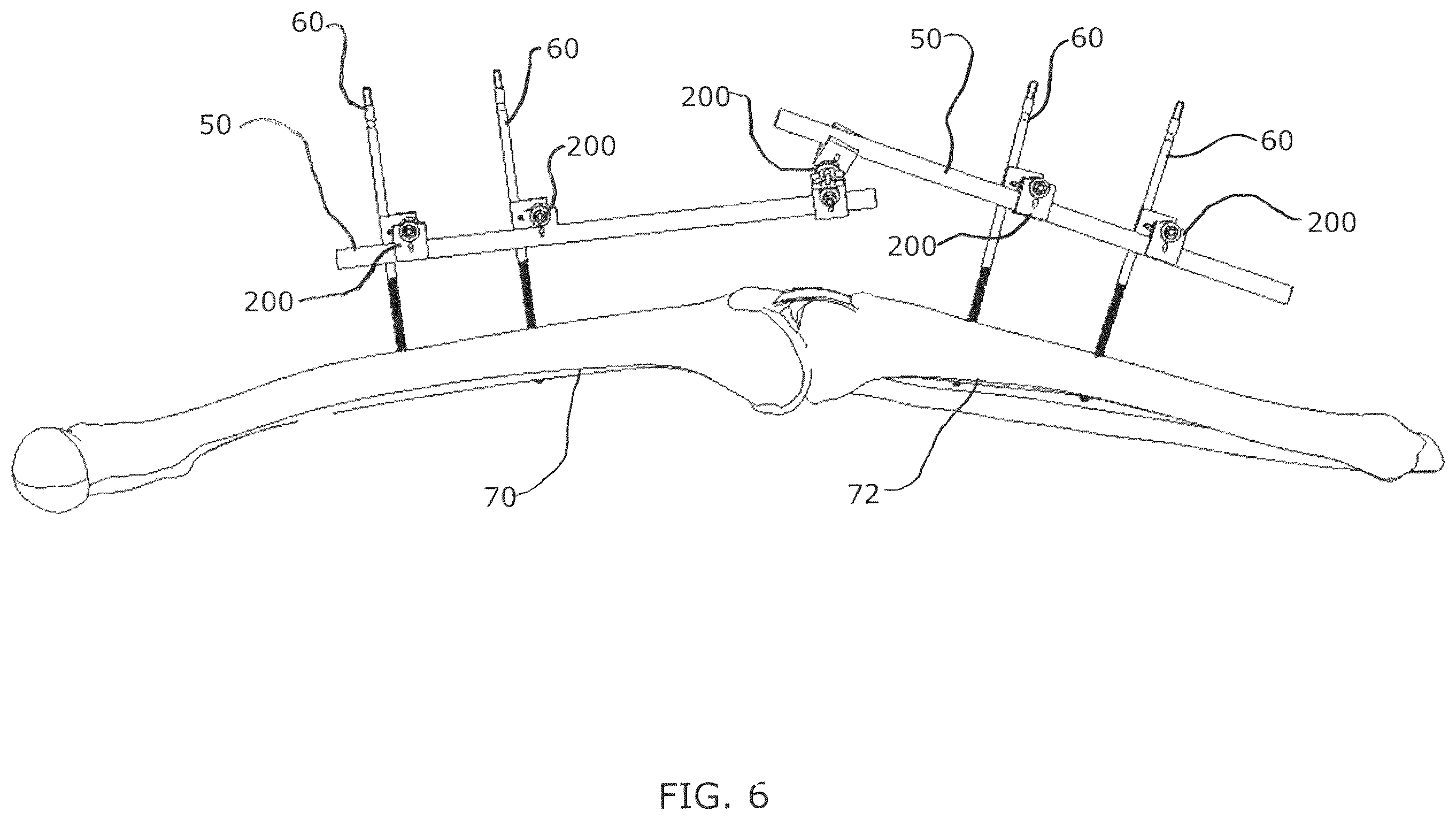 Patent US12376885 Figure 7 – External fixator assembly