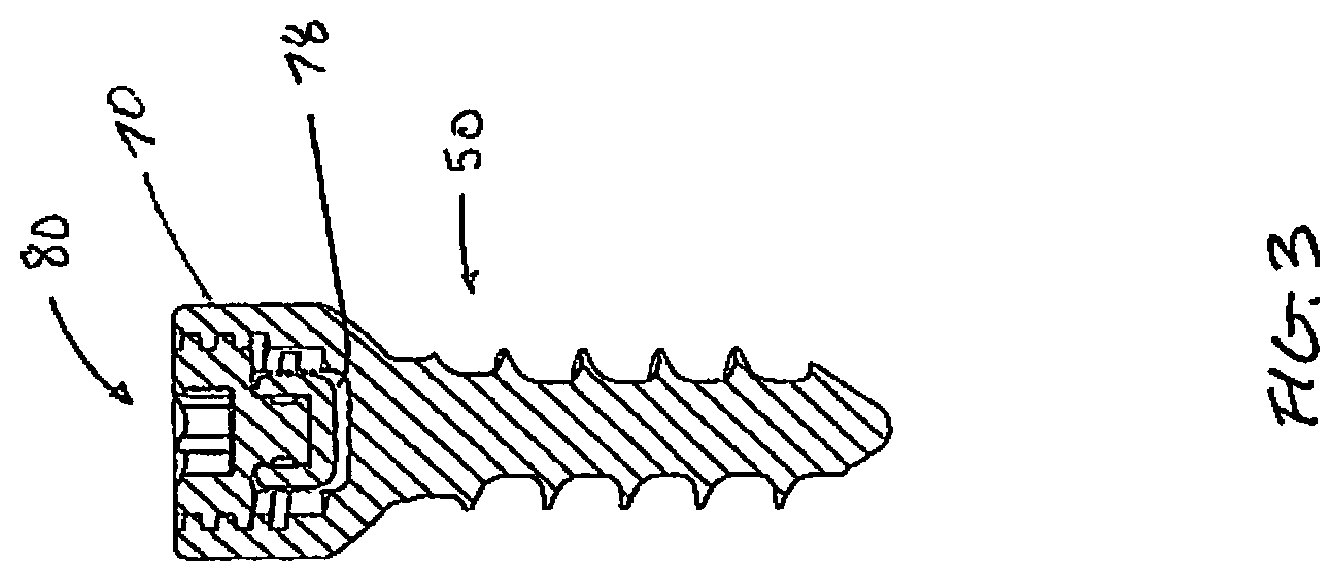 Patent US12376887 Figure 3 – Tethering screw system