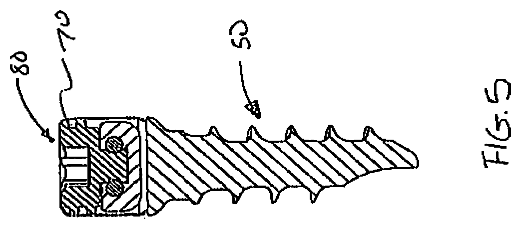 Patent US12376887 Figure 5 – Tethering screw system