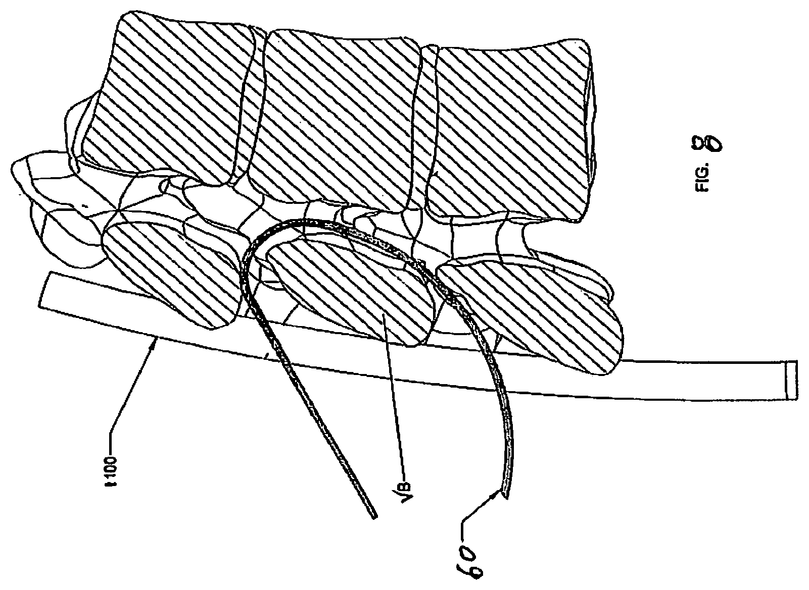 Patent US12376887 Figure 8 – Tethering screw system