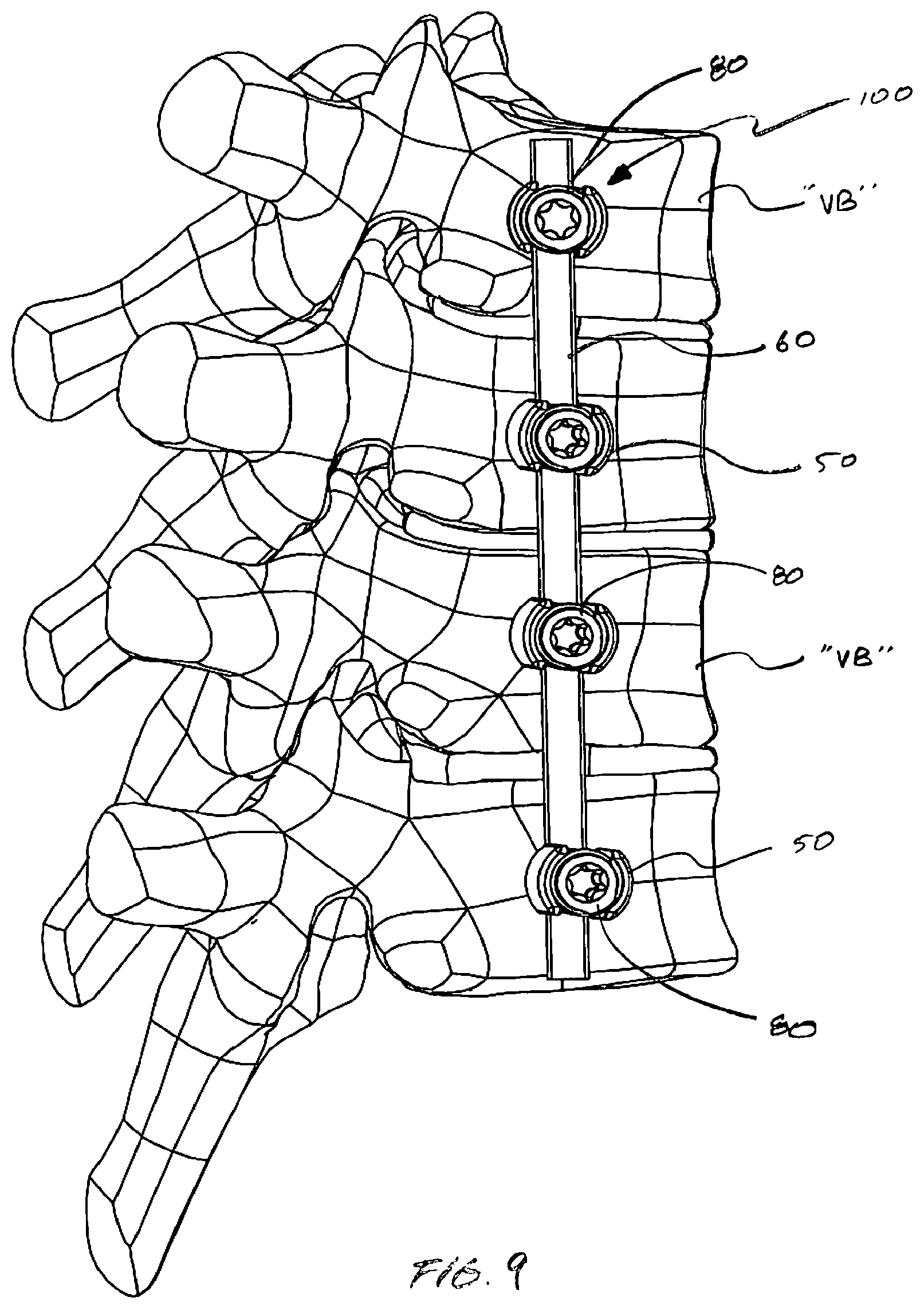 Patent US12376887 Figure 9 – Tethering screw system