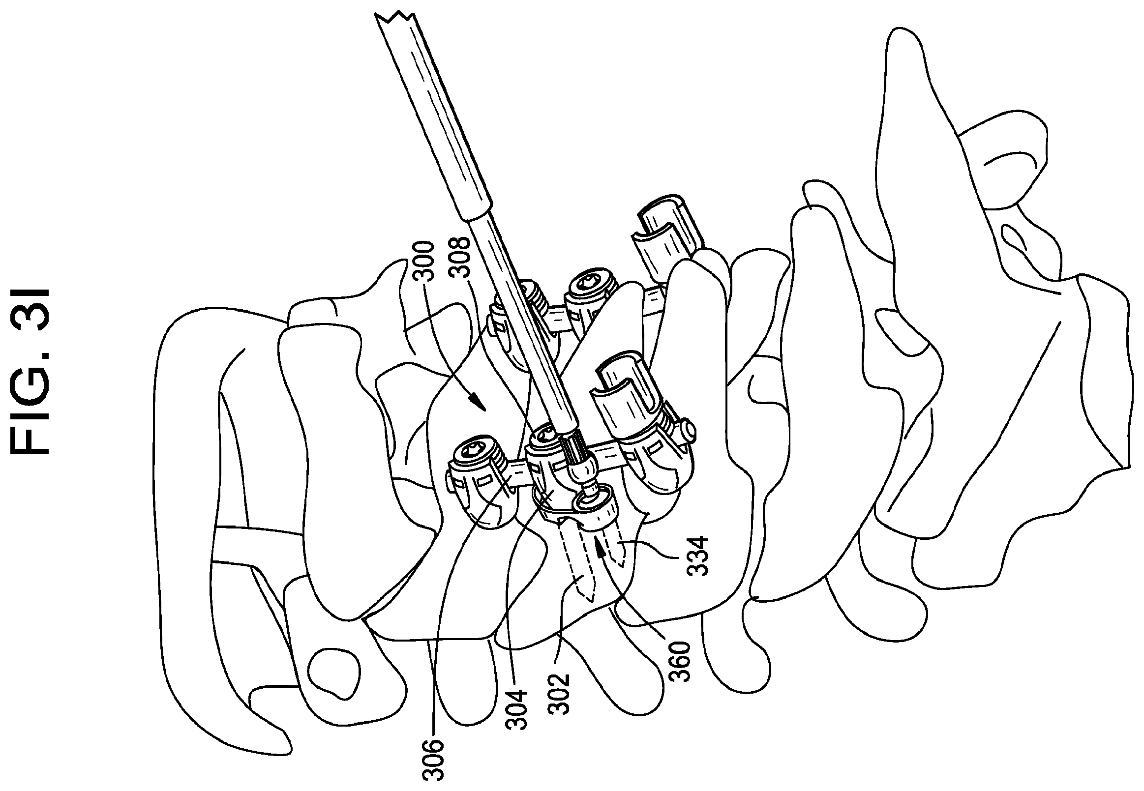 Patent US12376888 Figure 10 – Multipoint fixation implants