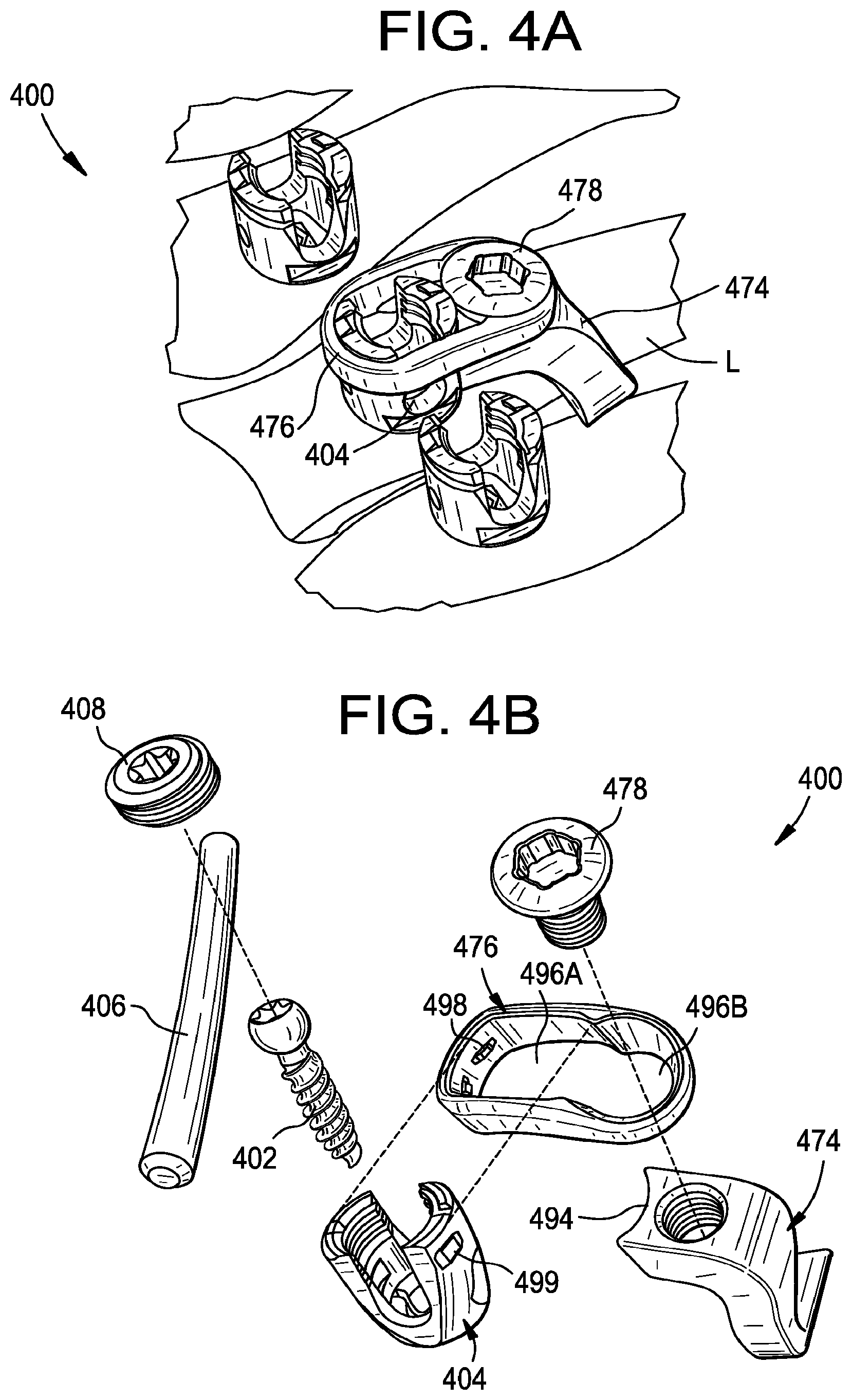 Patent US12376888 Figure 11 – Multipoint fixation implants