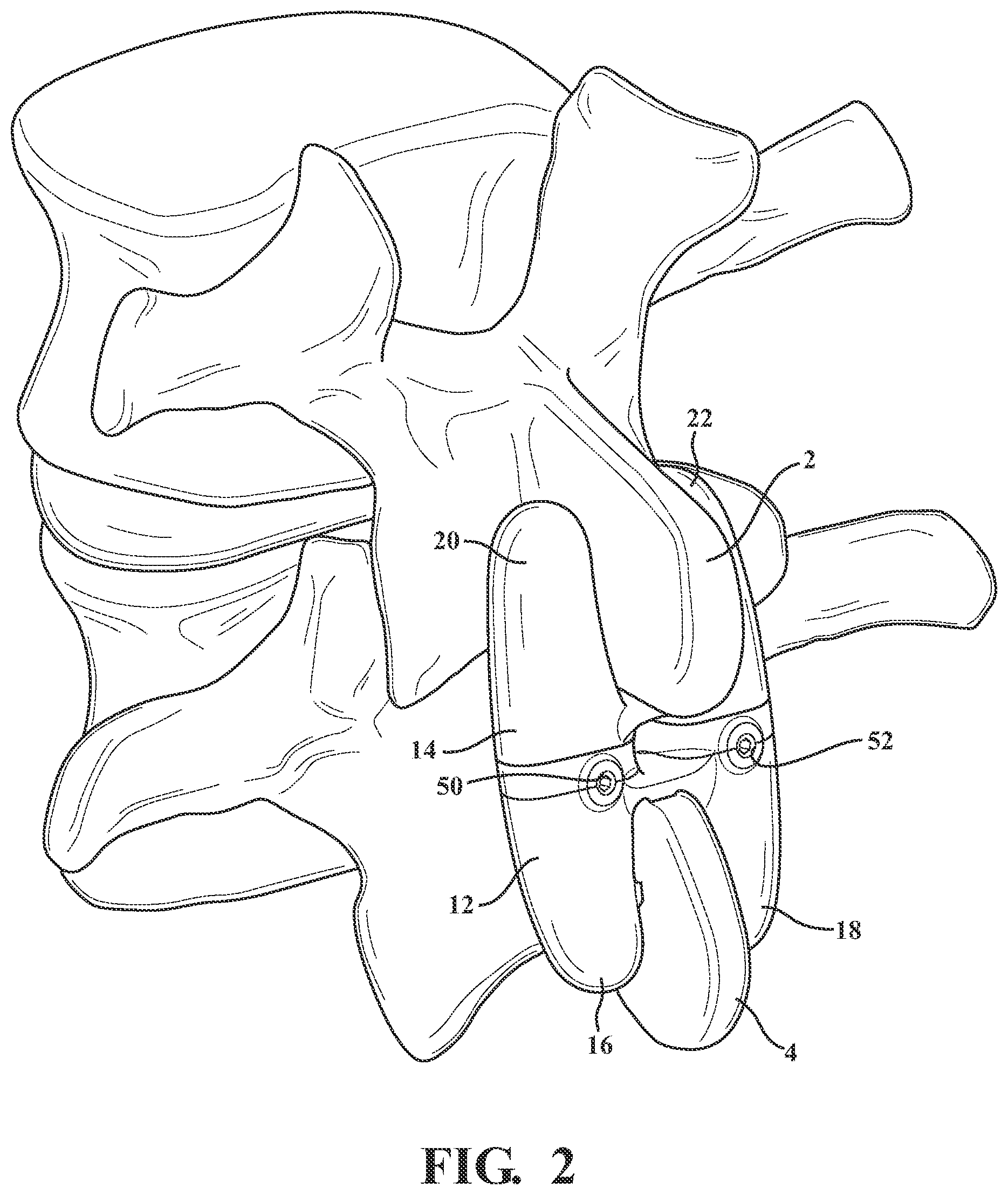 Patent US12376889 Figure 2 – Expandable spring stepped in jack for installation between upper and lower succeeding articular processes