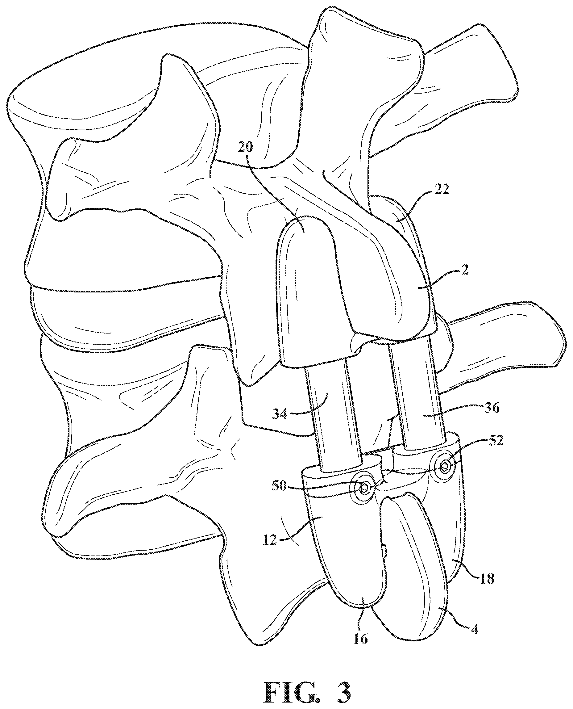 Patent US12376889 Figure 3 – Expandable spring stepped in jack for installation between upper and lower succeeding articular processes