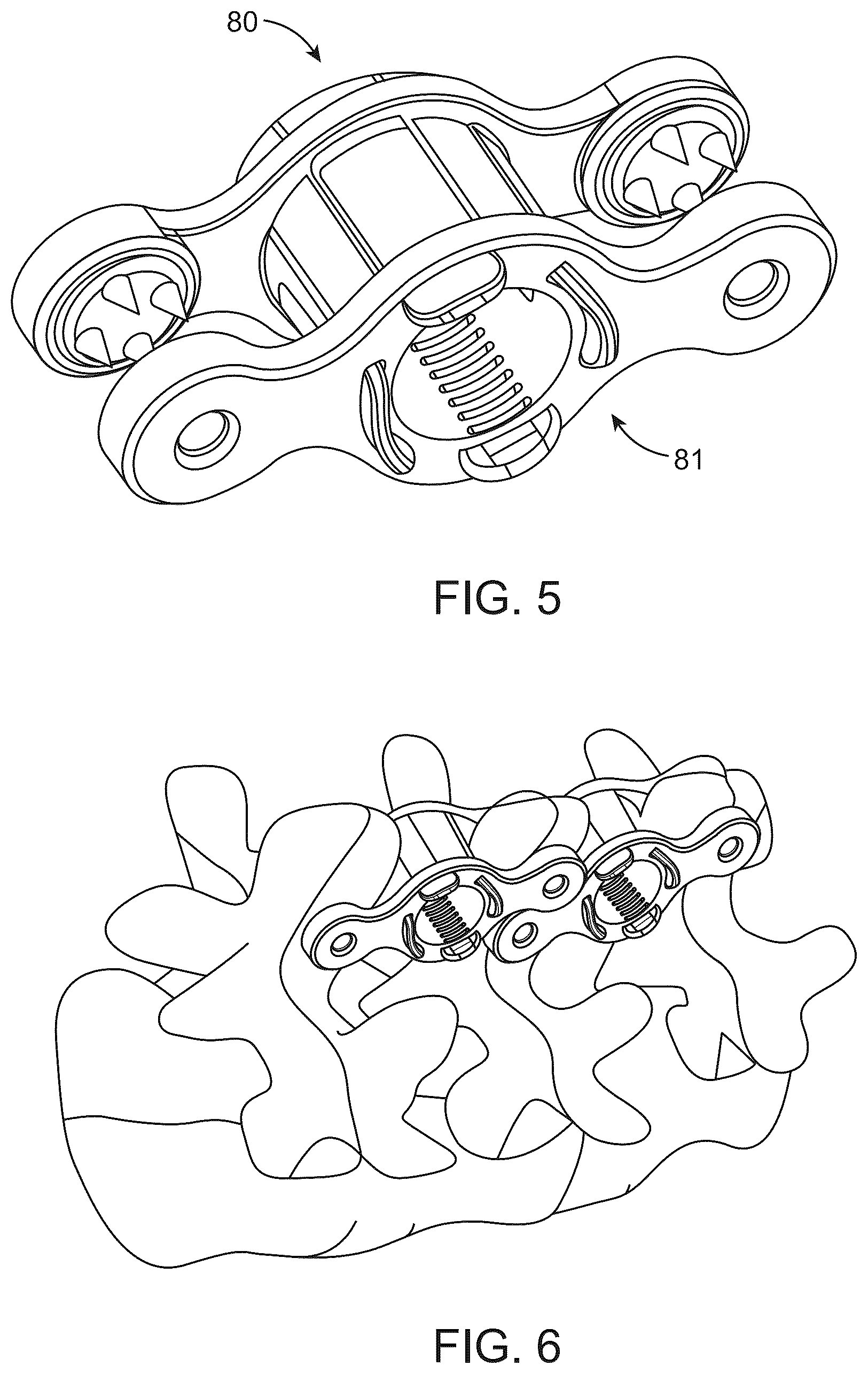 Patent US12376890 Figure 3 – Dynamic and non-dynamic interspinous fusion implant and bone growth stimulation system