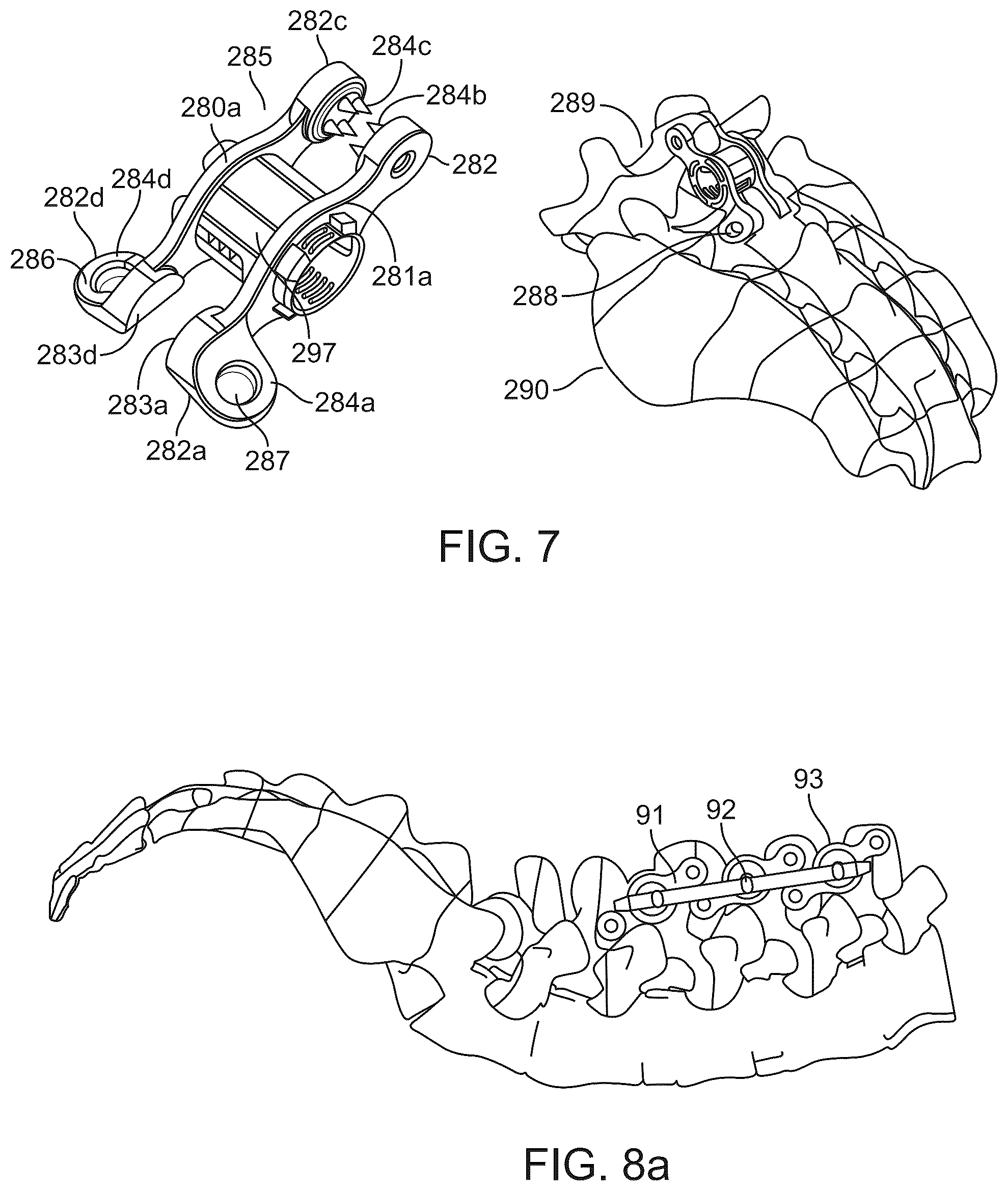 Patent US12376890 Figure 4 – Dynamic and non-dynamic interspinous fusion implant and bone growth stimulation system