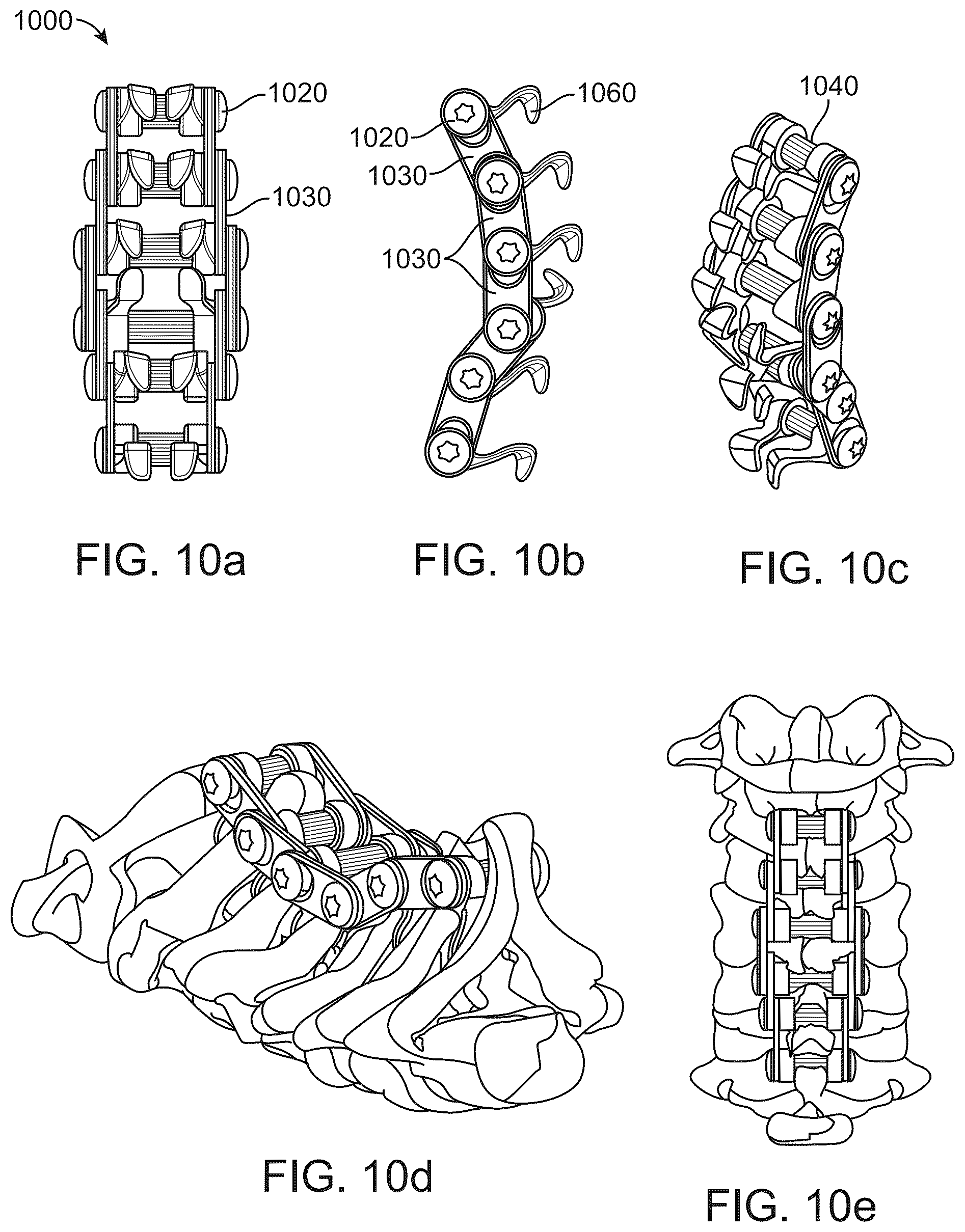 Patent US12376890 Figure 11 – Dynamic and non-dynamic interspinous fusion implant and bone growth stimulation system