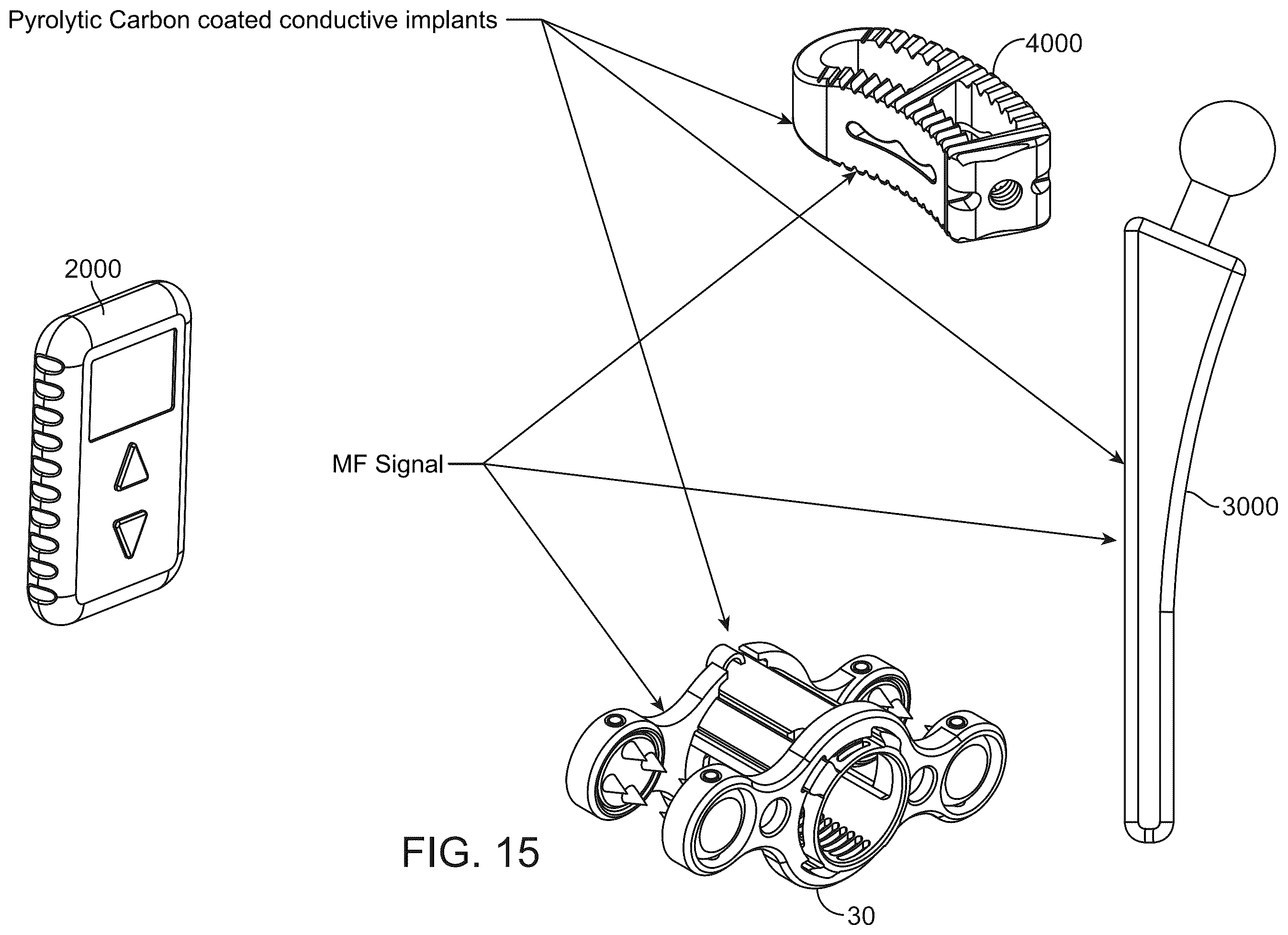 Patent US12376890 Figure 17 – Dynamic and non-dynamic interspinous fusion implant and bone growth stimulation system