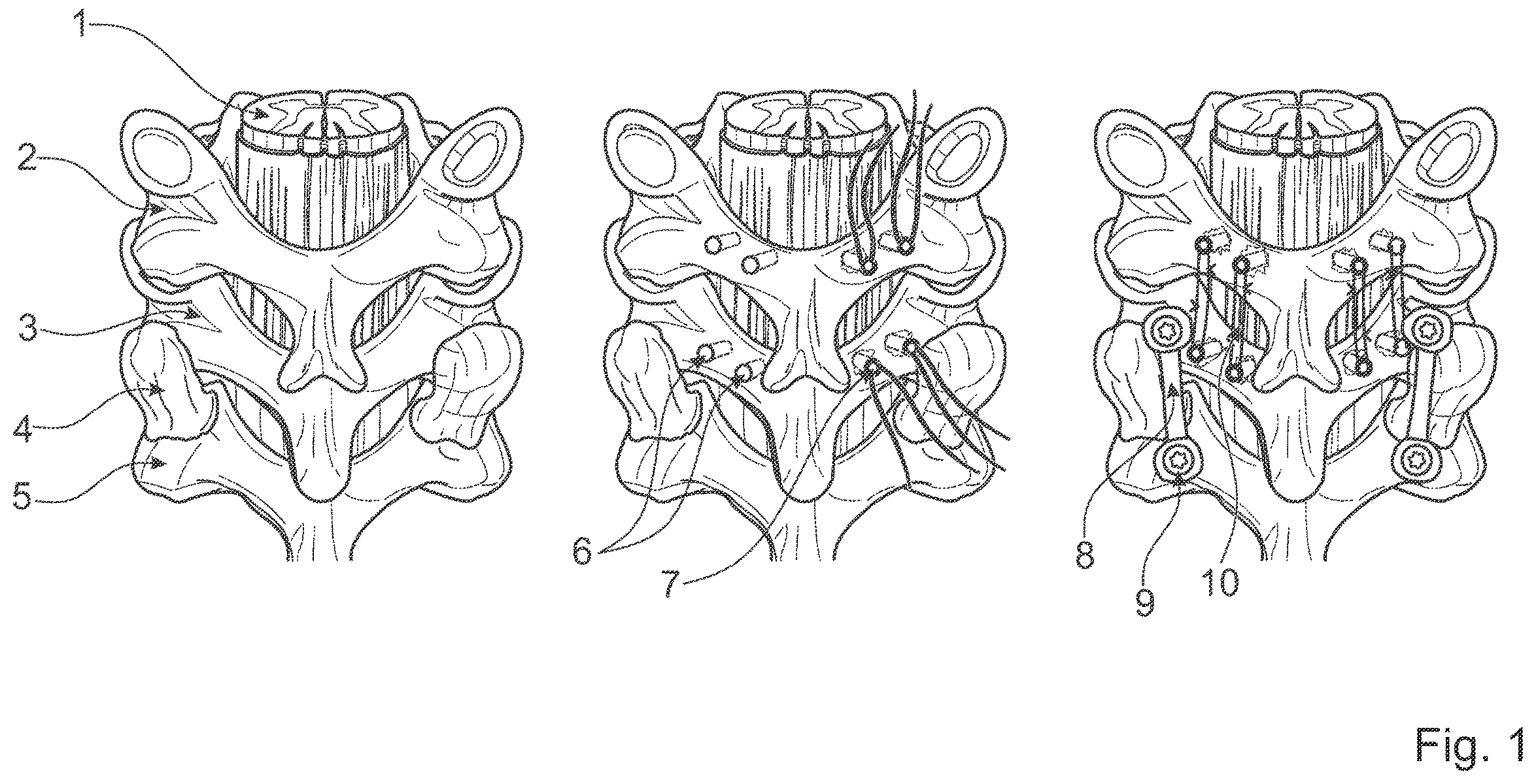 Patent US12376891 Figure 1 – Surgical methods for the treatment of spinal stenosis