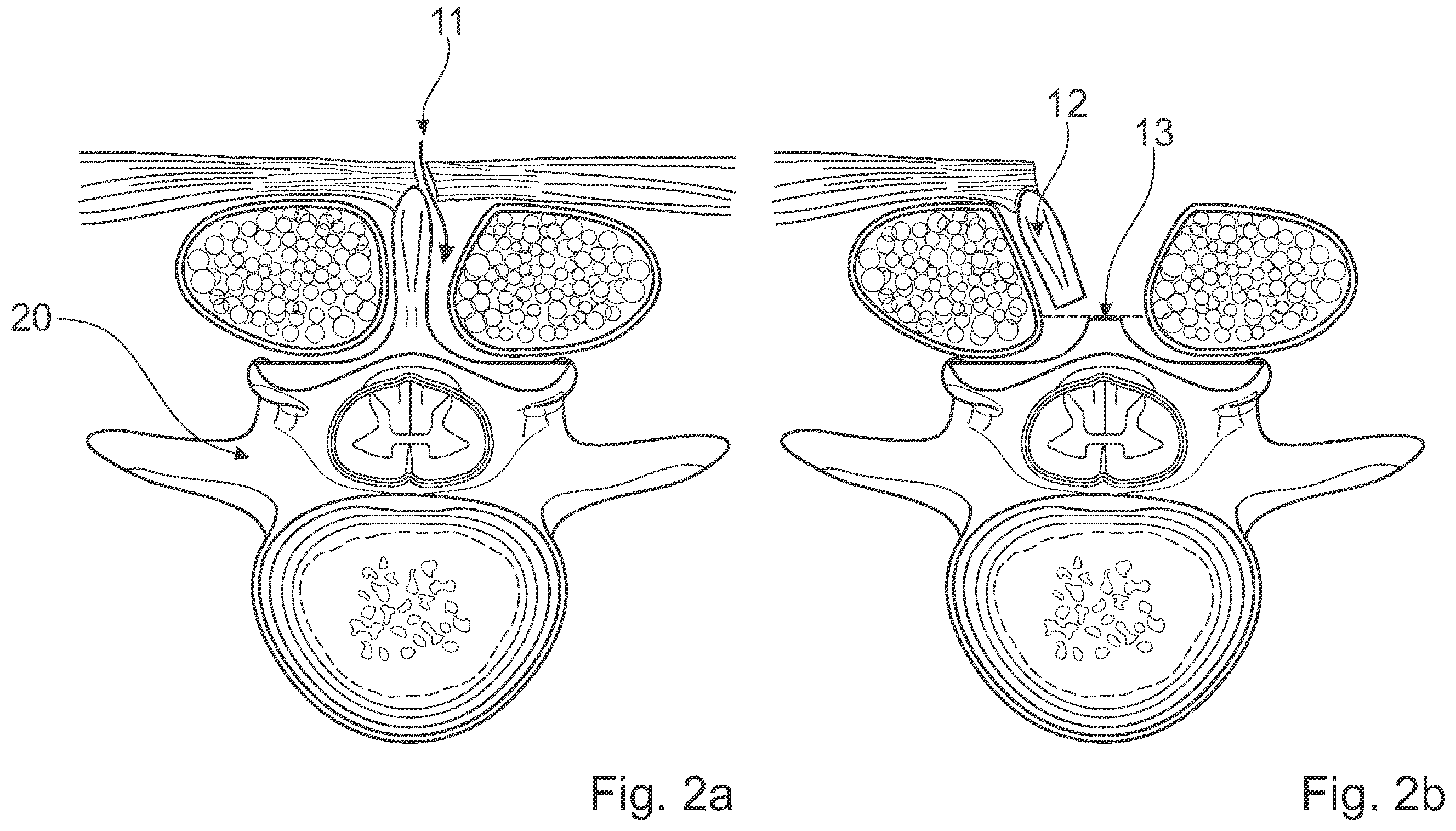 Patent US12376891 Figure 2 – Surgical methods for the treatment of spinal stenosis
