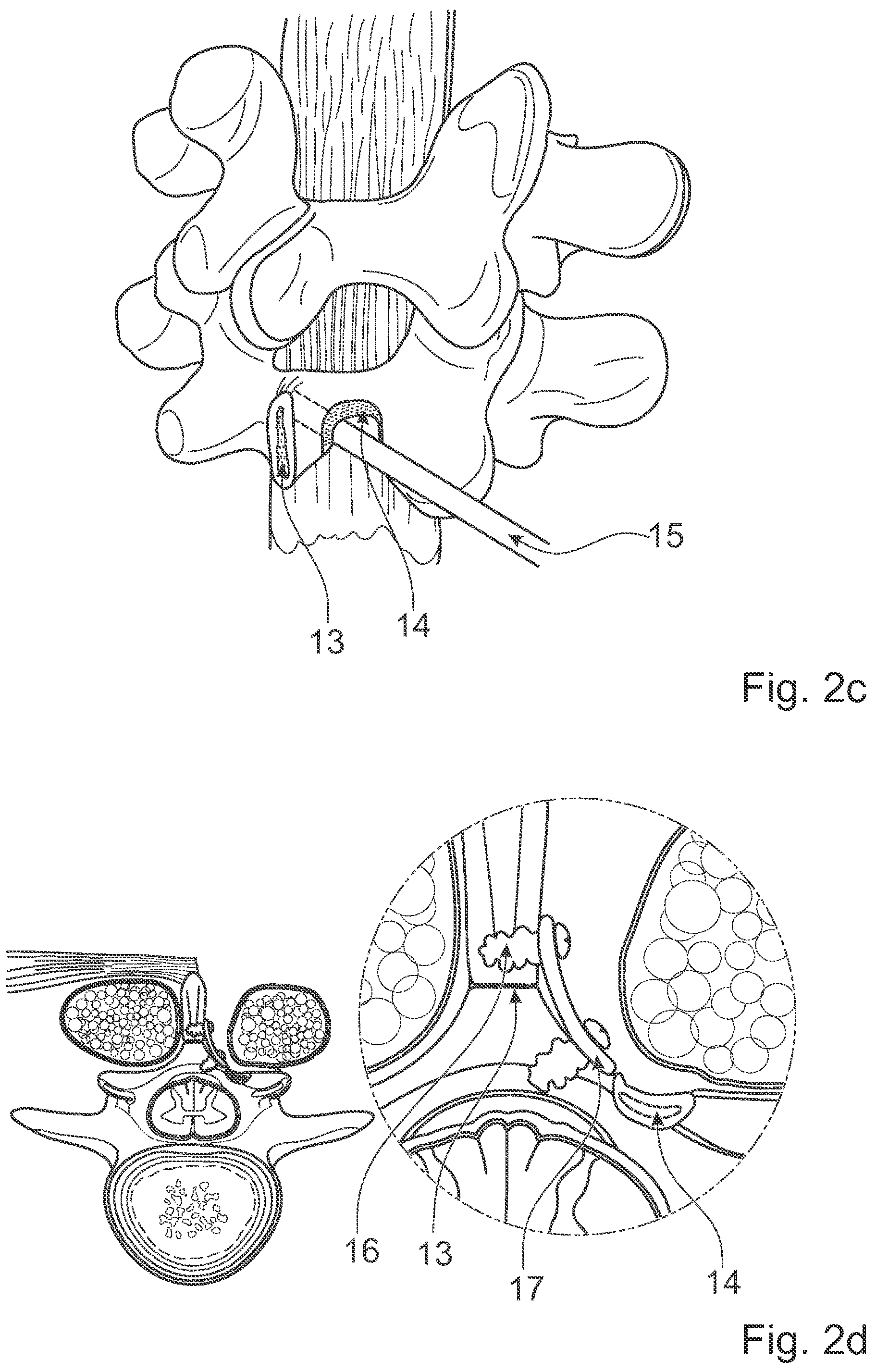 Patent US12376891 Figure 3 – Surgical methods for the treatment of spinal stenosis