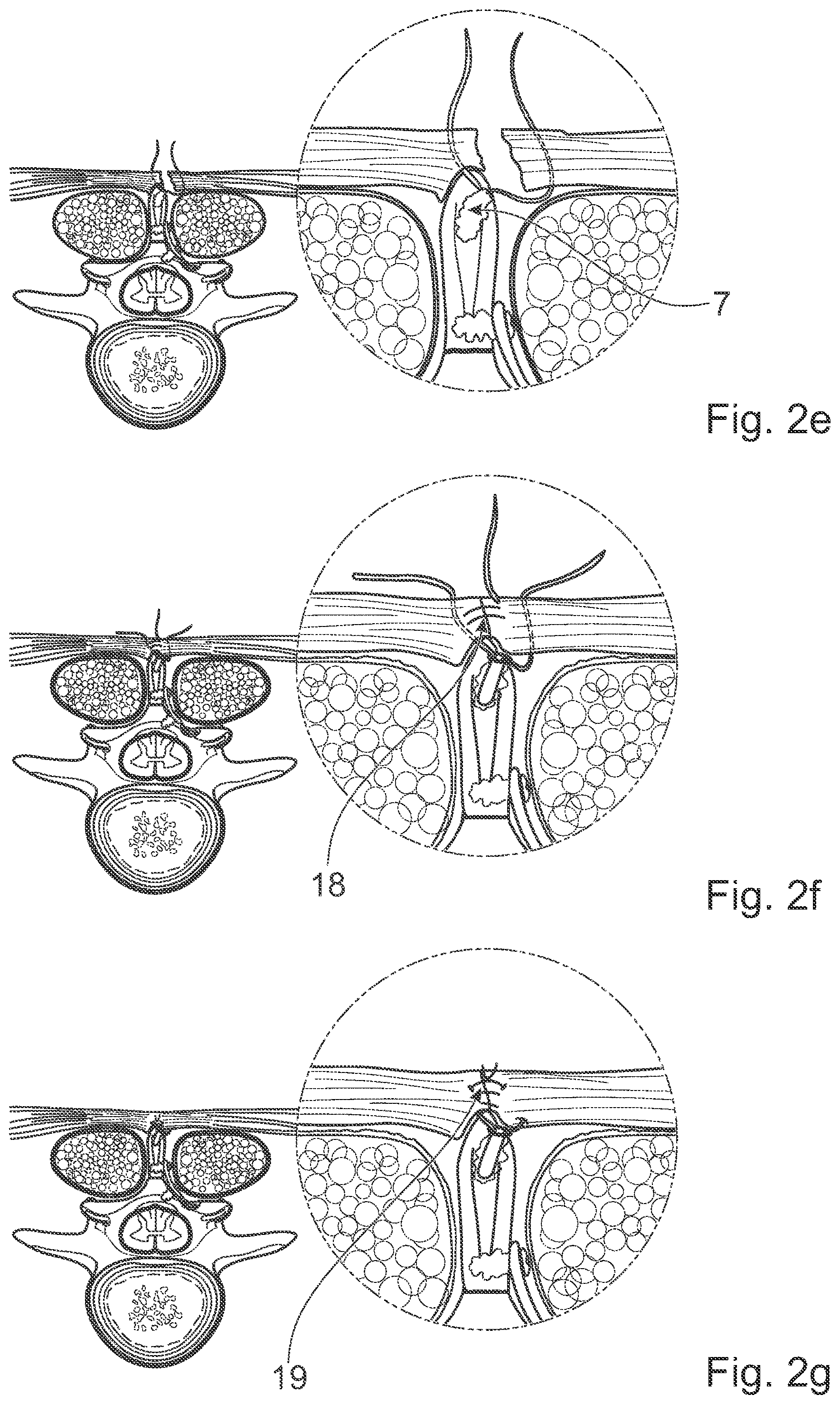Patent US12376891 Figure 4 – Surgical methods for the treatment of spinal stenosis