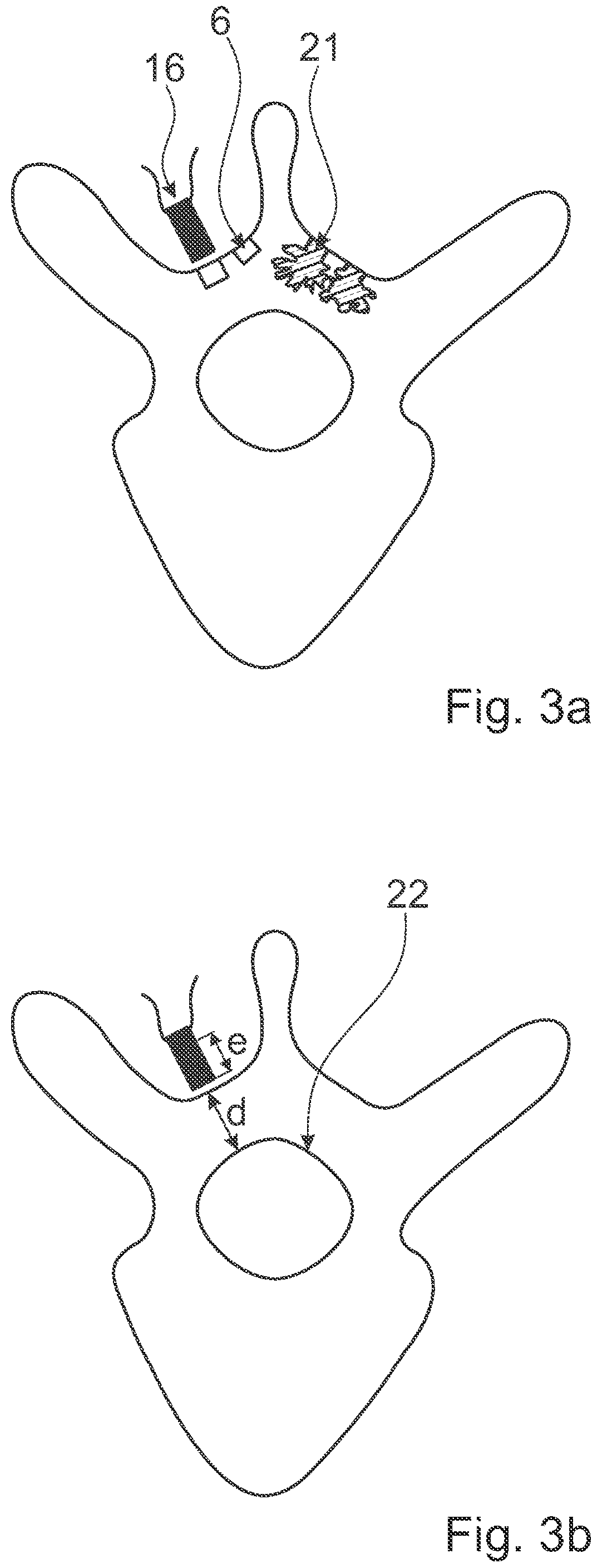 Patent US12376891 Figure 5 – Surgical methods for the treatment of spinal stenosis