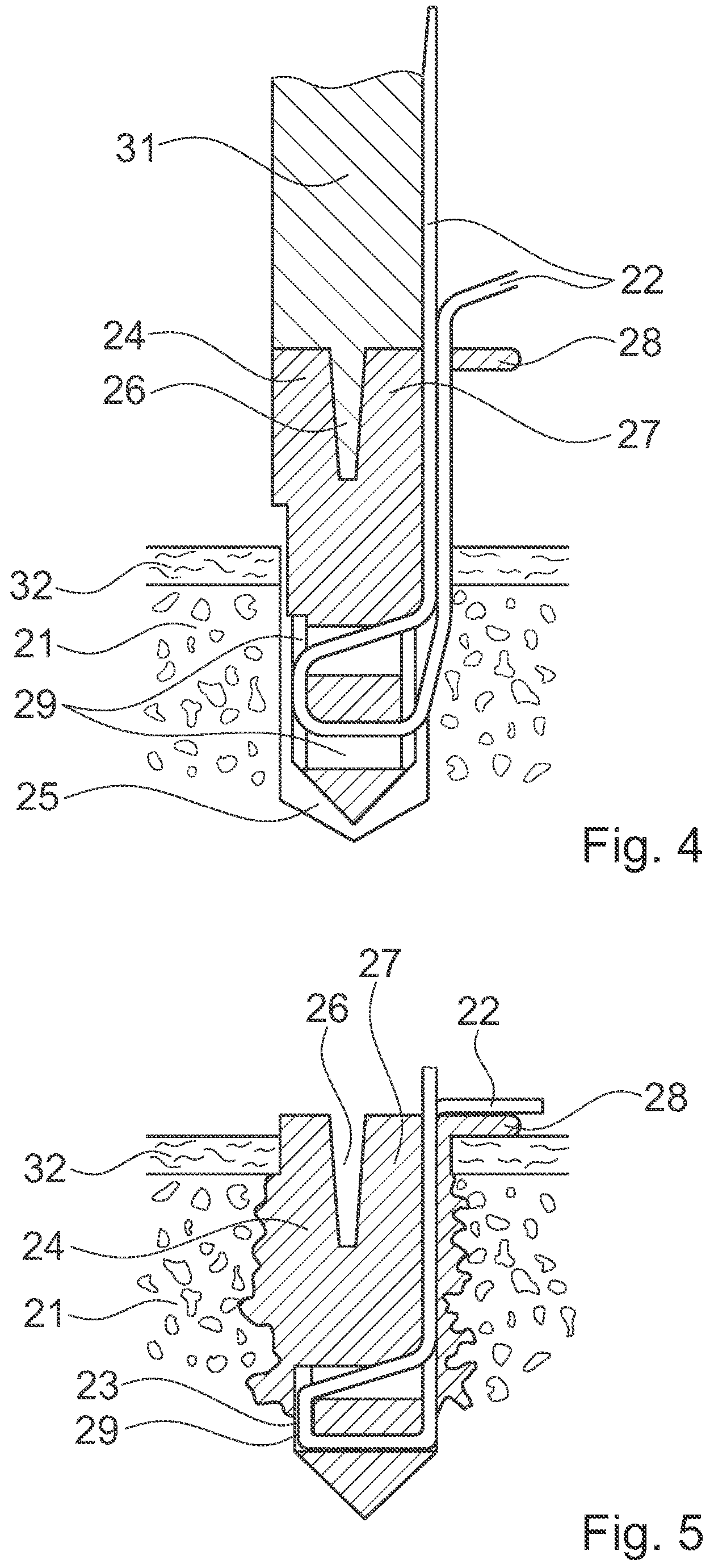 Patent US12376891 Figure 6 – Surgical methods for the treatment of spinal stenosis