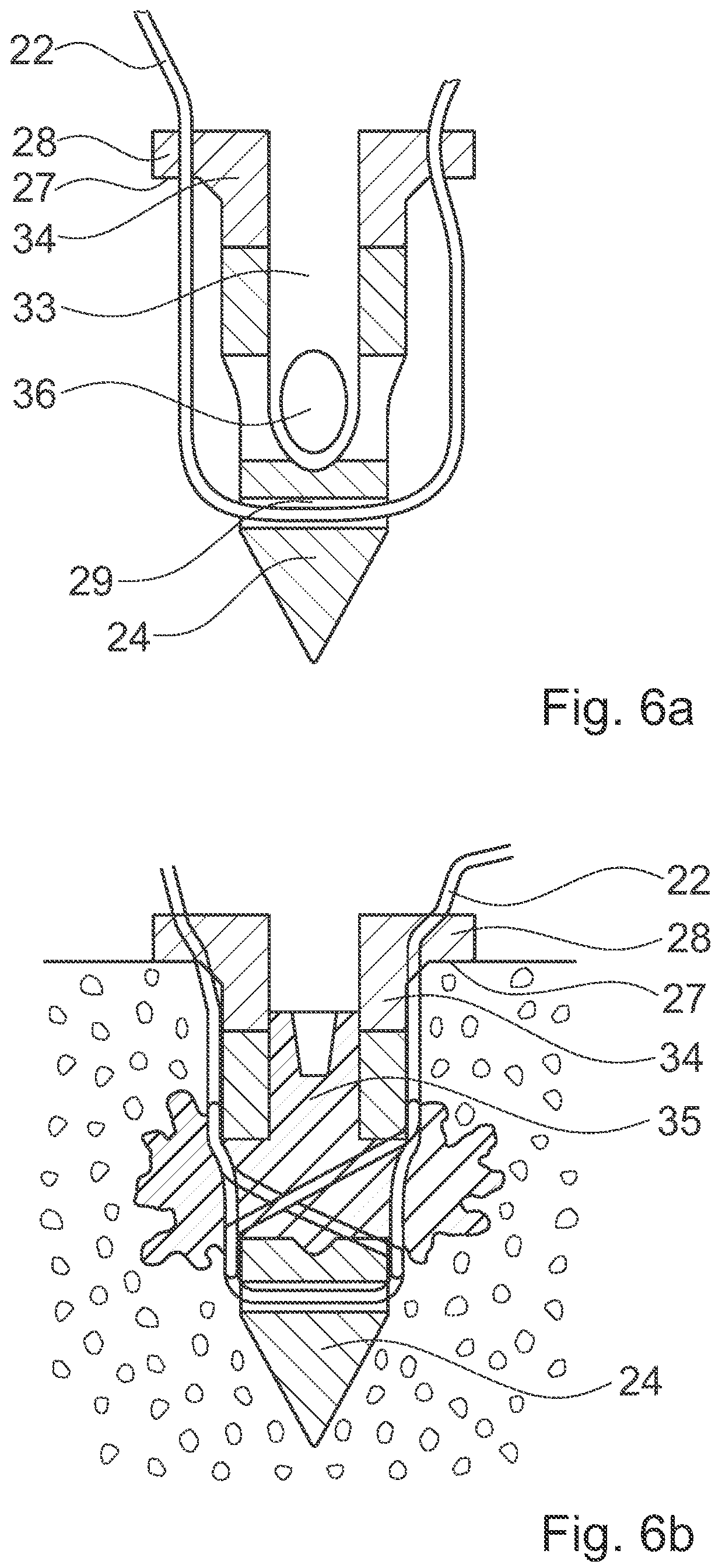 Patent US12376891 Figure 7 – Surgical methods for the treatment of spinal stenosis
