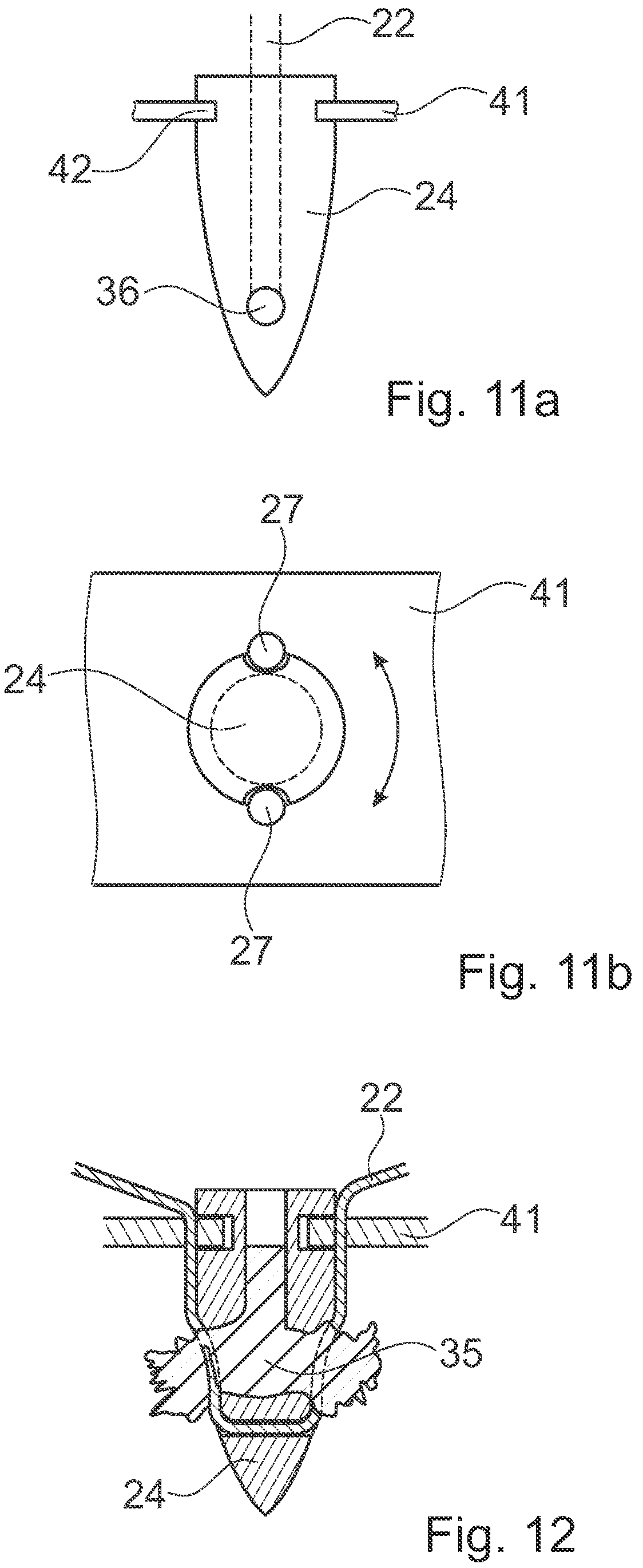Patent US12376891 Figure 9 – Surgical methods for the treatment of spinal stenosis