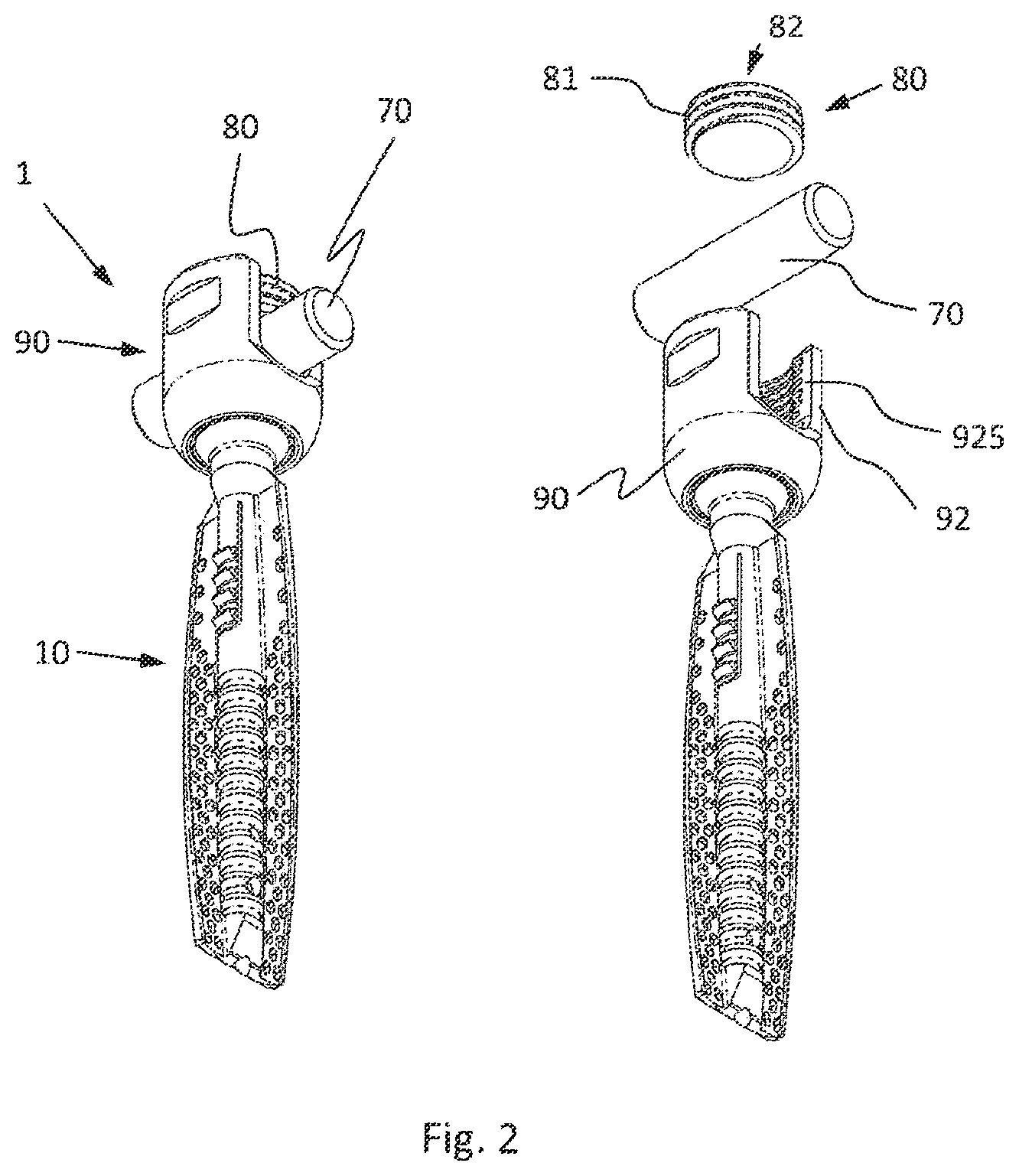 Patent US12376892 Figure 2 – Bone-anchoring device for a pedicle access