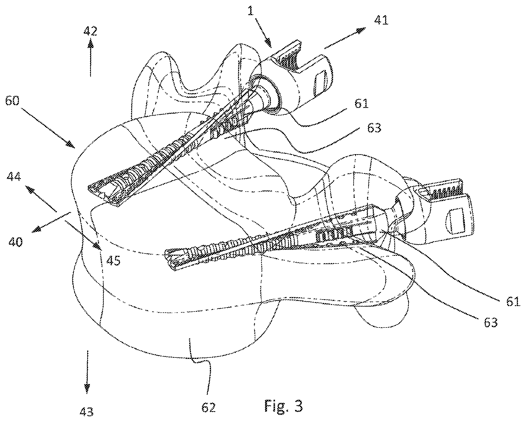 Patent US12376892 Figure 3 – Bone-anchoring device for a pedicle access
