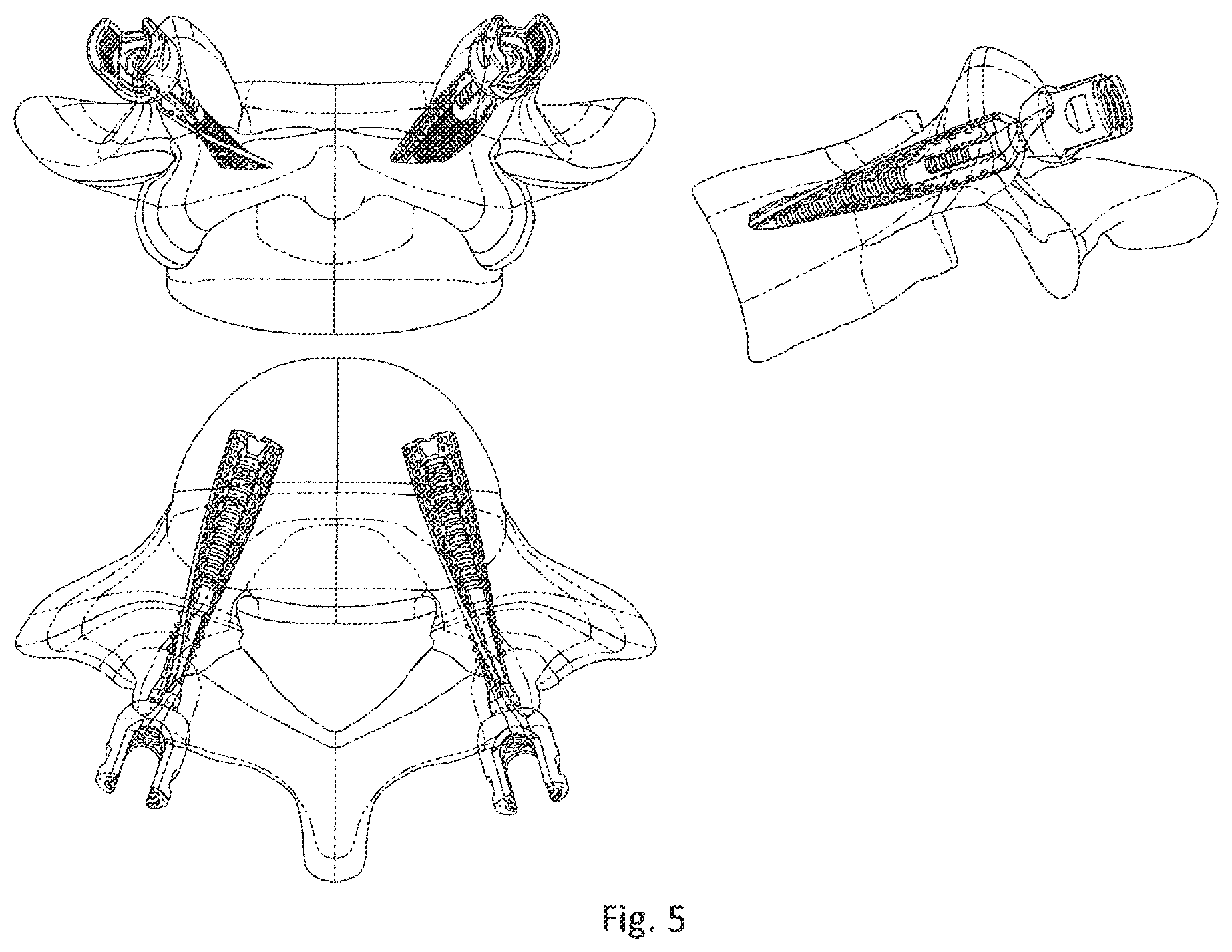 Patent US12376892 Figure 5 – Bone-anchoring device for a pedicle access