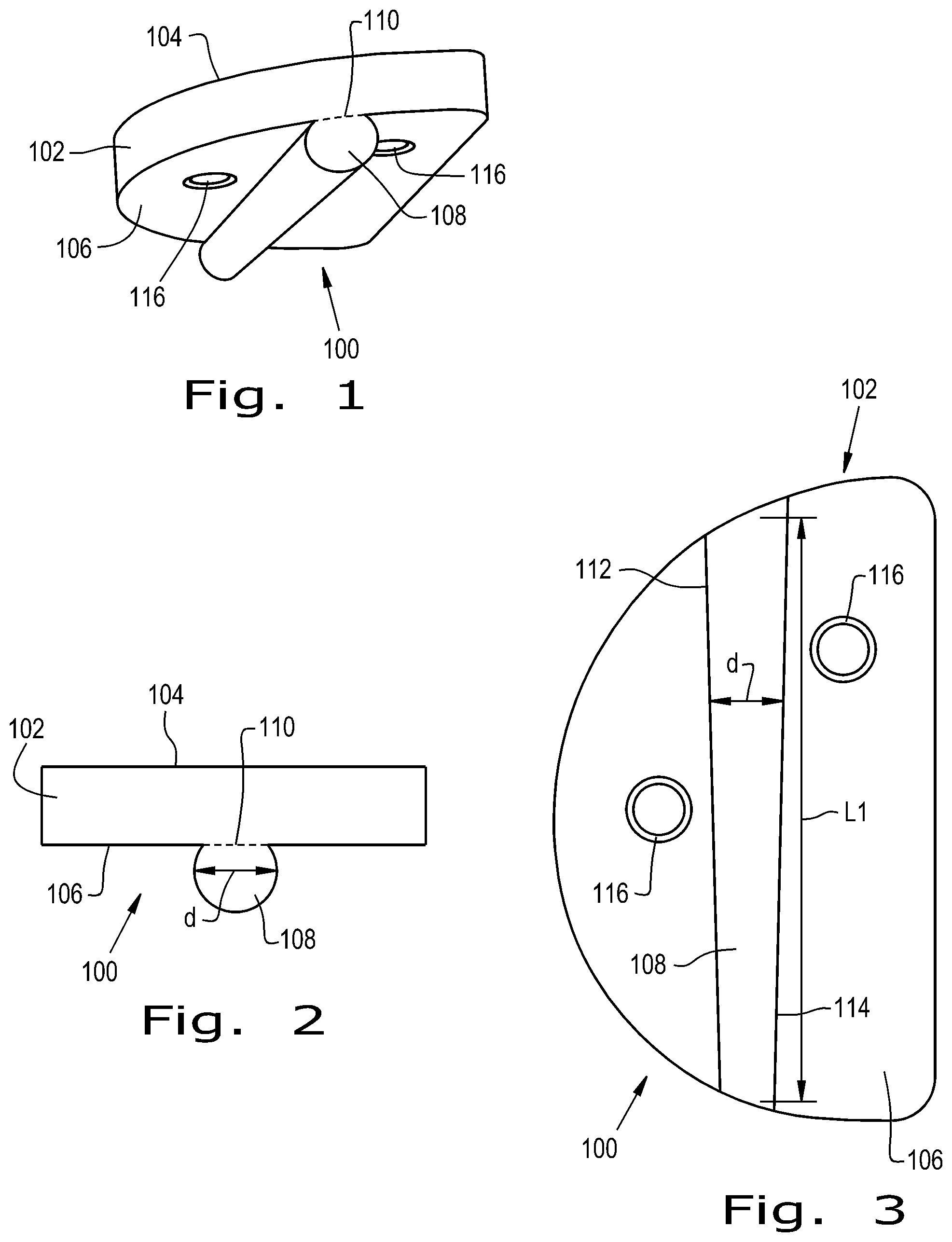 Patent US12376893 Figure 1 – Orthopaedic implant with fixation feature and a method of implanting thereof