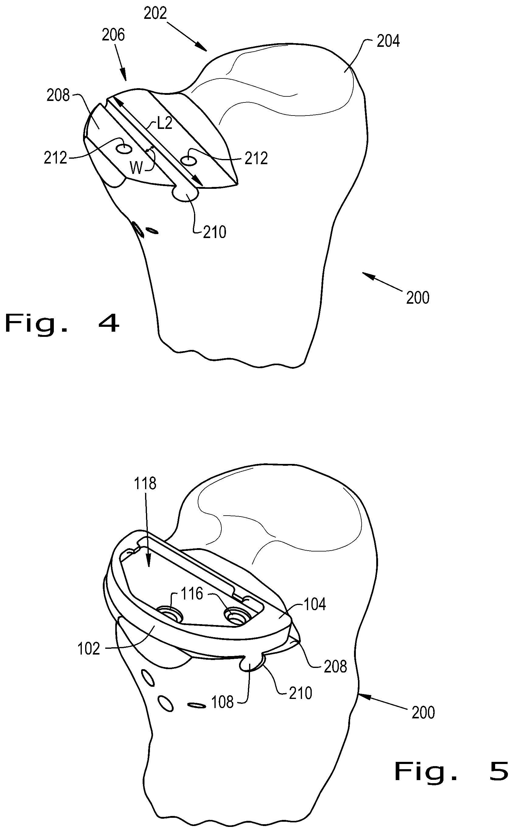 Patent US12376893 Figure 2 – Orthopaedic implant with fixation feature and a method of implanting thereof