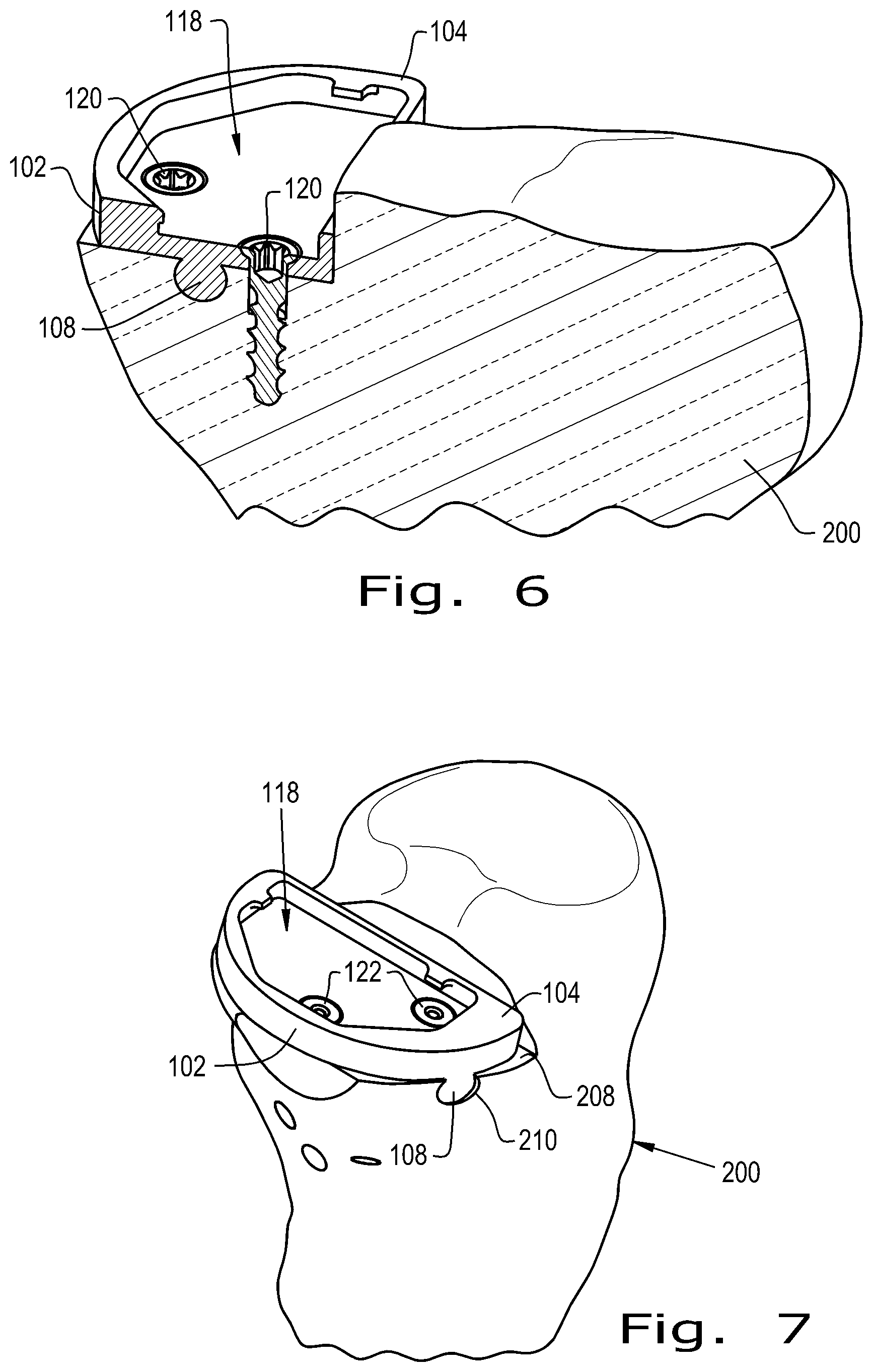 Patent US12376893 Figure 3 – Orthopaedic implant with fixation feature and a method of implanting thereof
