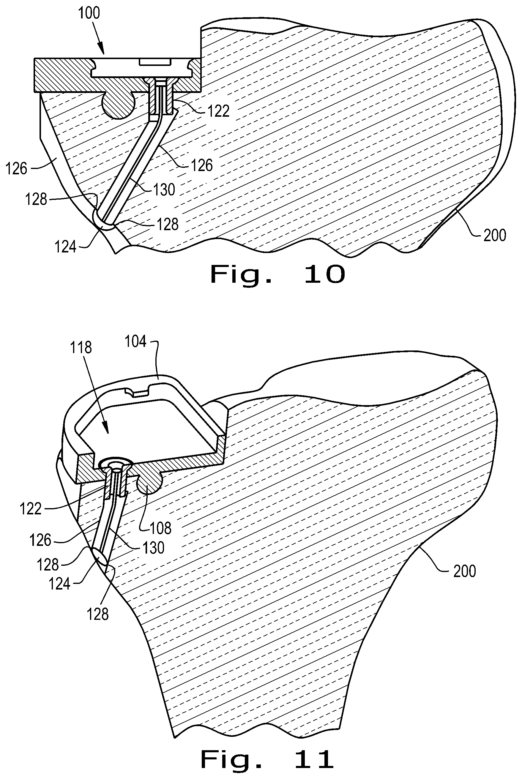 Patent US12376893 Figure 5 – Orthopaedic implant with fixation feature and a method of implanting thereof