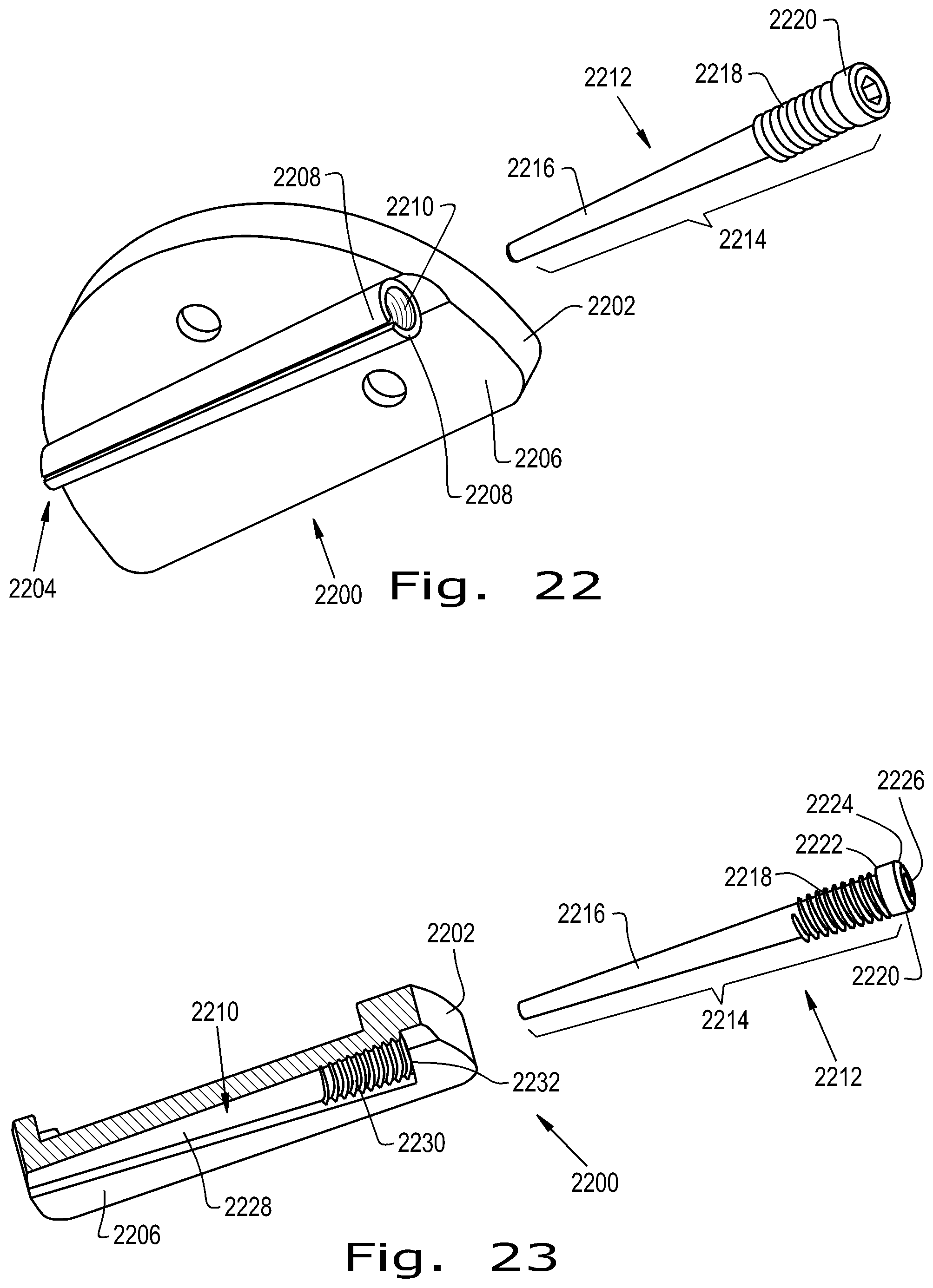 Patent US12376893 Figure 11 – Orthopaedic implant with fixation feature and a method of implanting thereof