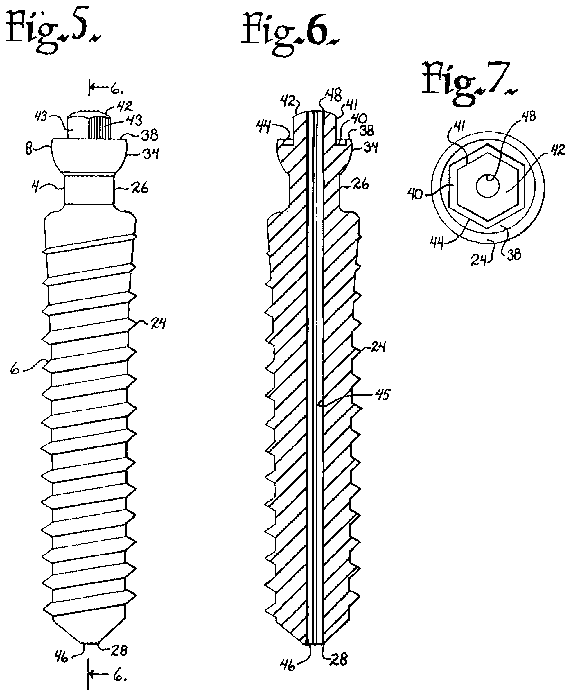 Patent US12376894 Figure 2 – Pivotal bone anchor assembly with ring retainer and twist-in-place pressure insert