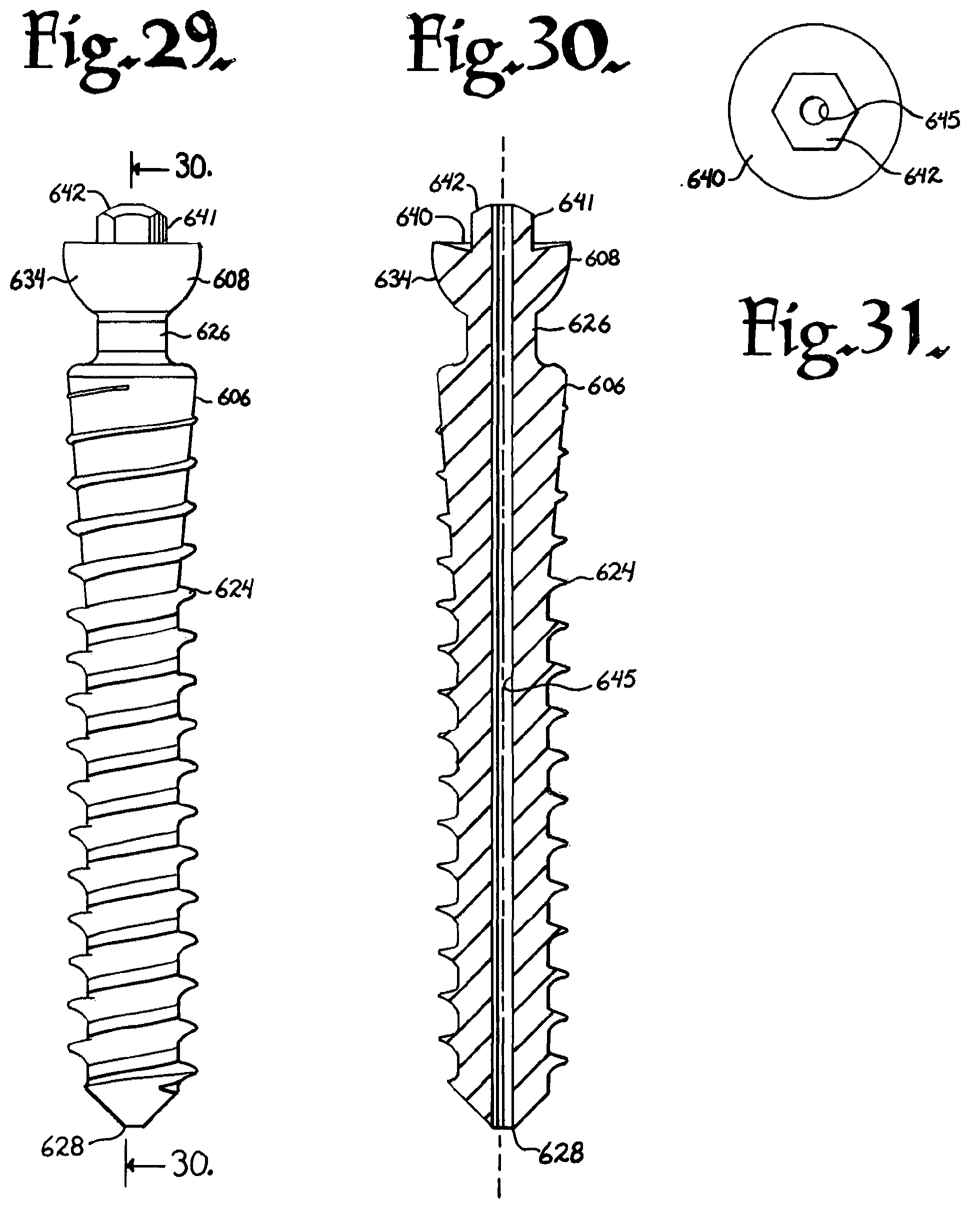 Patent US12376894 Figure 11 – Pivotal bone anchor assembly with ring retainer and twist-in-place pressure insert