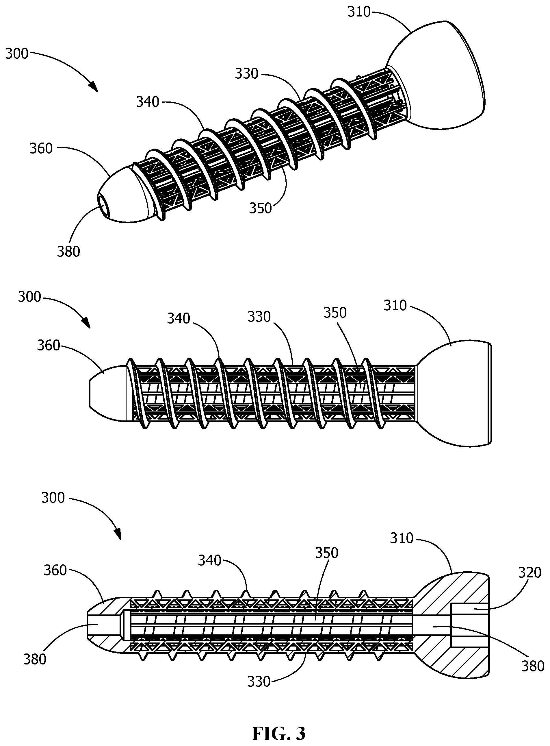 Patent US12376895 Figure 3 – Implants for tissue fixation and fusion