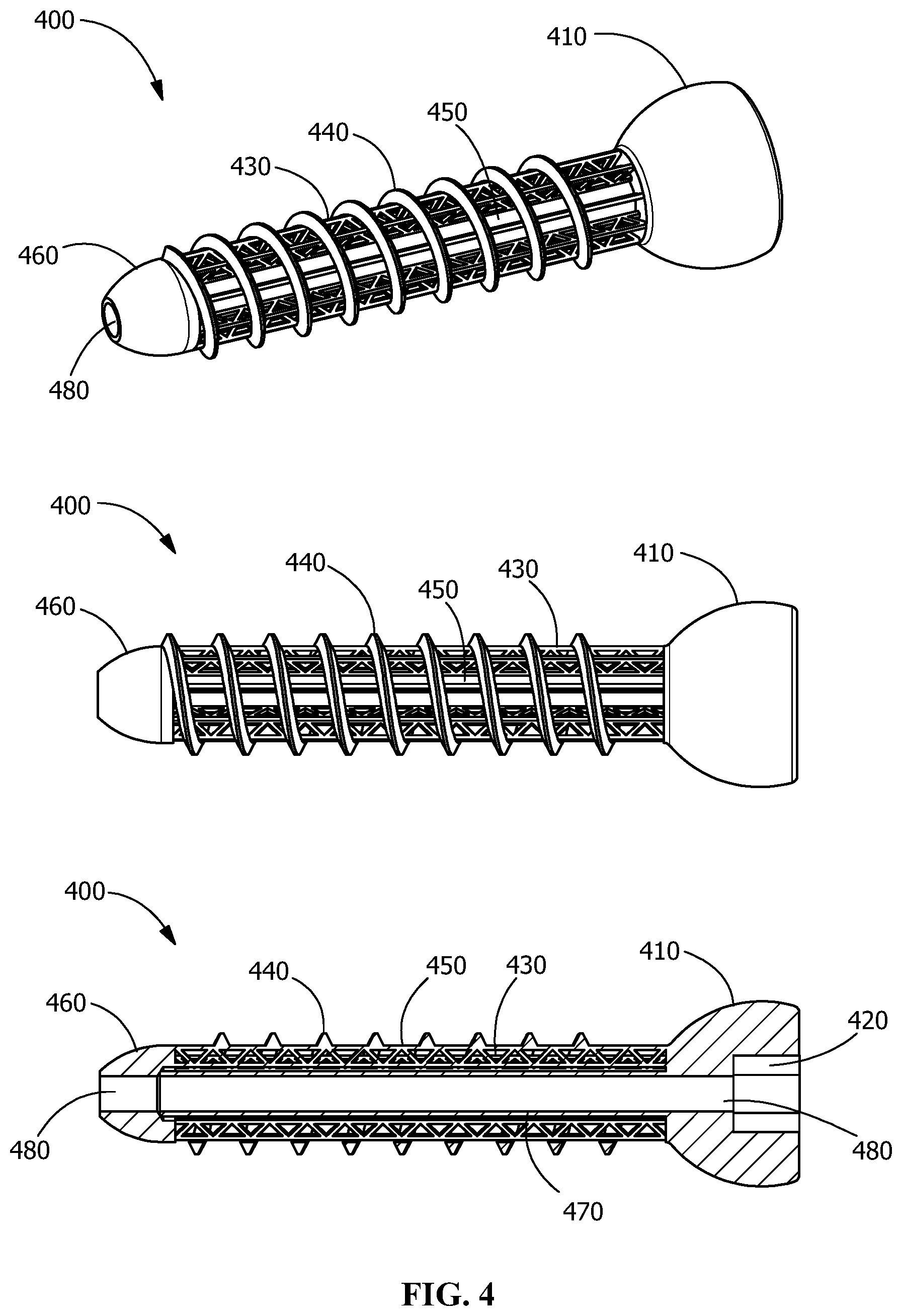 Patent US12376895 Figure 4 – Implants for tissue fixation and fusion